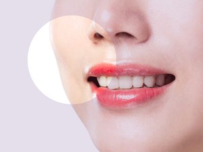 Liệu trình tiêm filler làm đầy rãnh cười xóa nếp nhăn hiệu quả