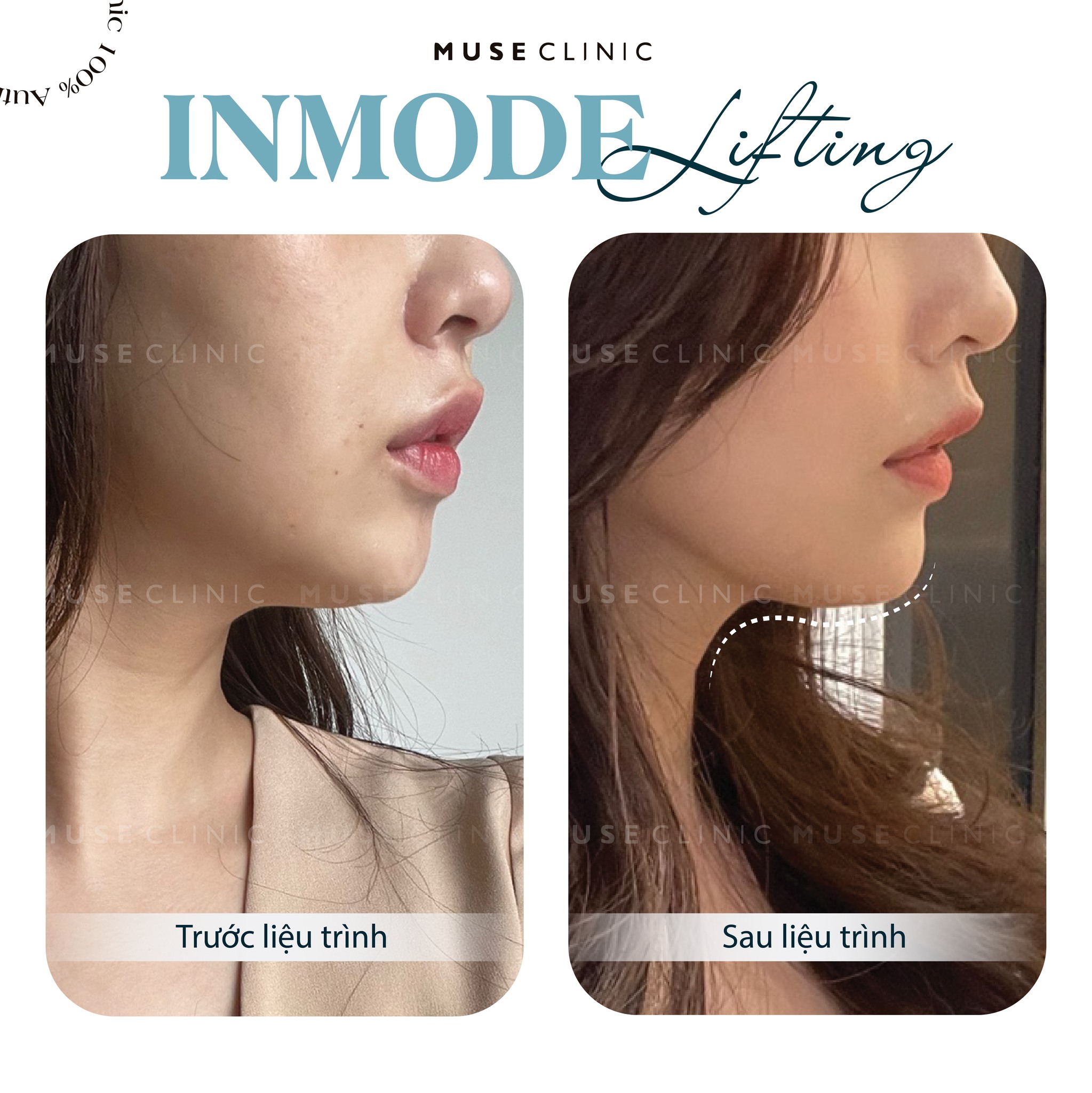 Top 5 công nghệ nâng cơ, trẻ hóa da nổi bật hiện nay