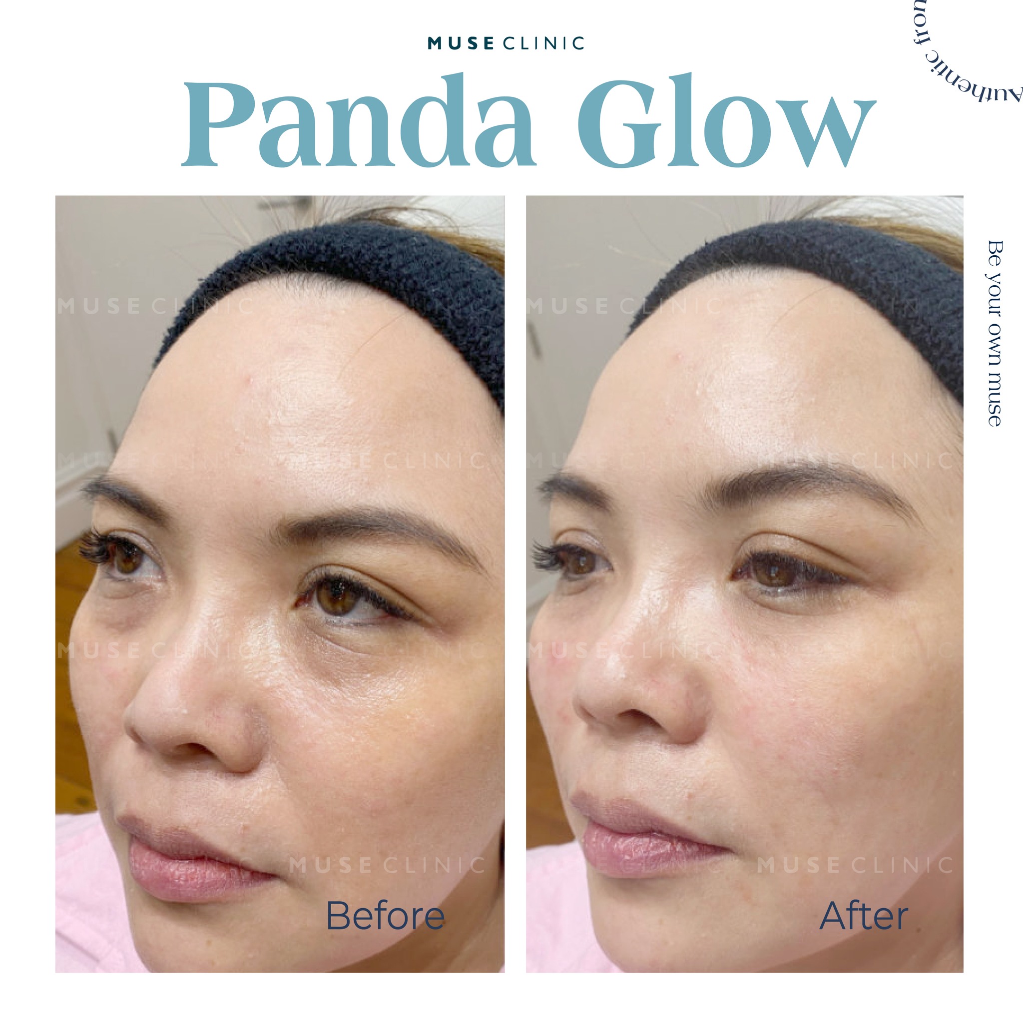 BỘ 3 TRẺ HÓA VÙNG MẮT THẾ HỆ MỚI KHÔNG CẦN PHẪU THUẬT - GIẢI PHÁP CHO ĐÔI MẮT TƯƠI TRẺ TỰ NHIÊN 