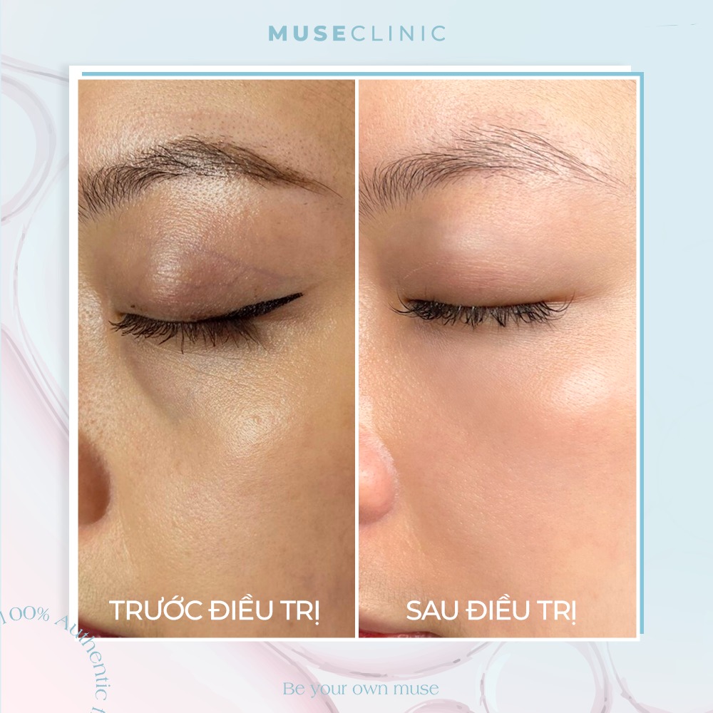 Jalupro Extra – Giải pháp trẻ hóa da sinh học sâu từ bên trong