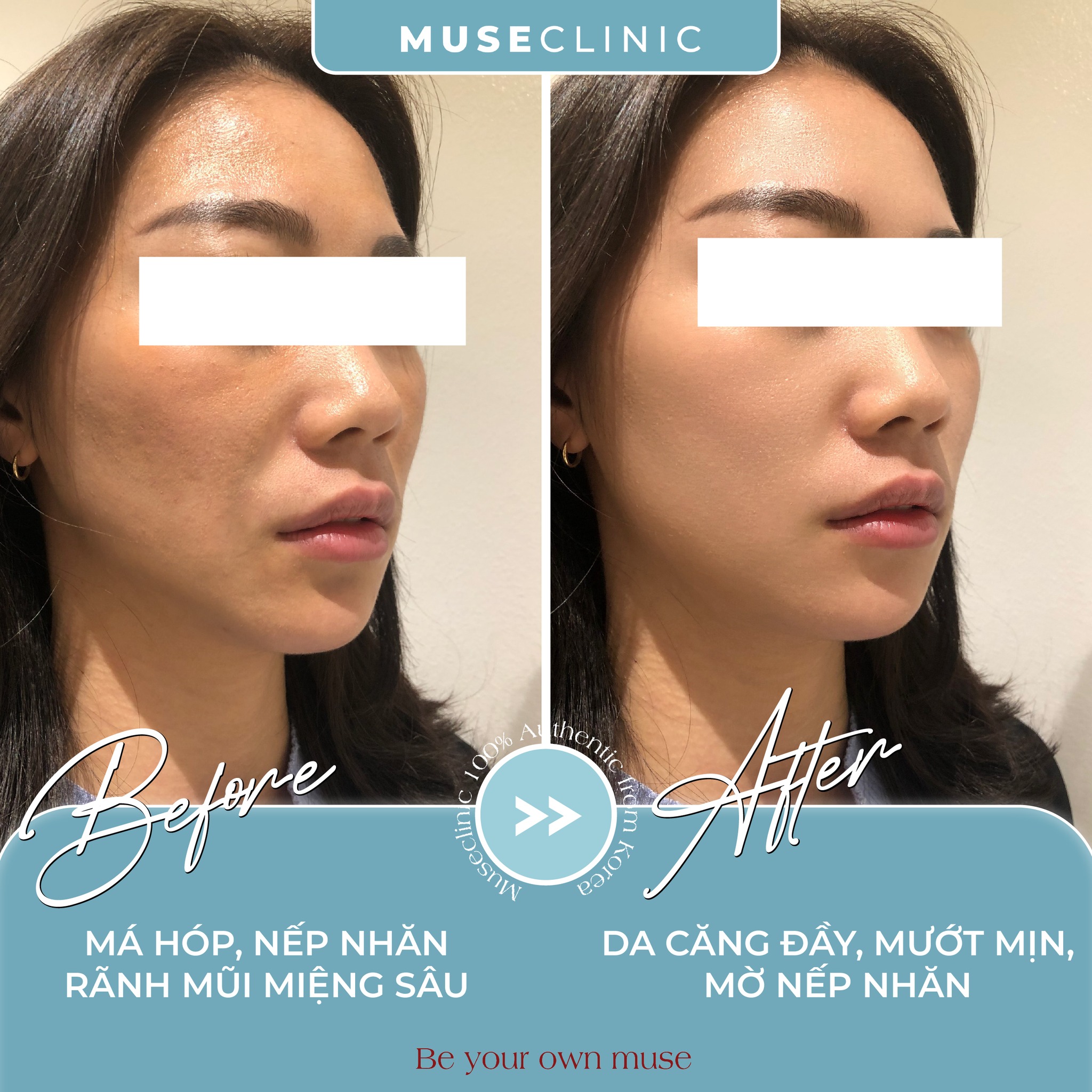 Sculptra, Juvelook hay Olidia? Skin Booster nào là “chân ái” để phục hồi thể tích và làn da? 
