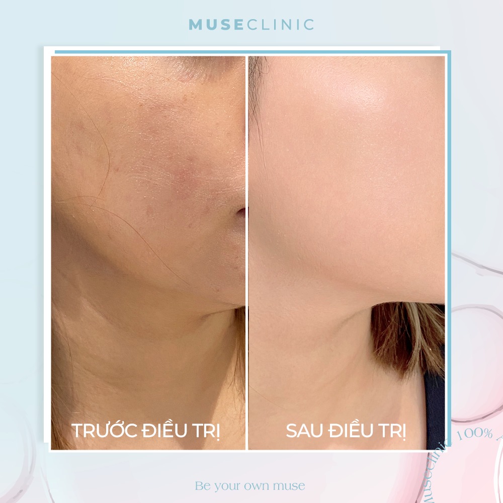 Jalupro Extra – Giải pháp trẻ hóa da sinh học sâu từ bên trong