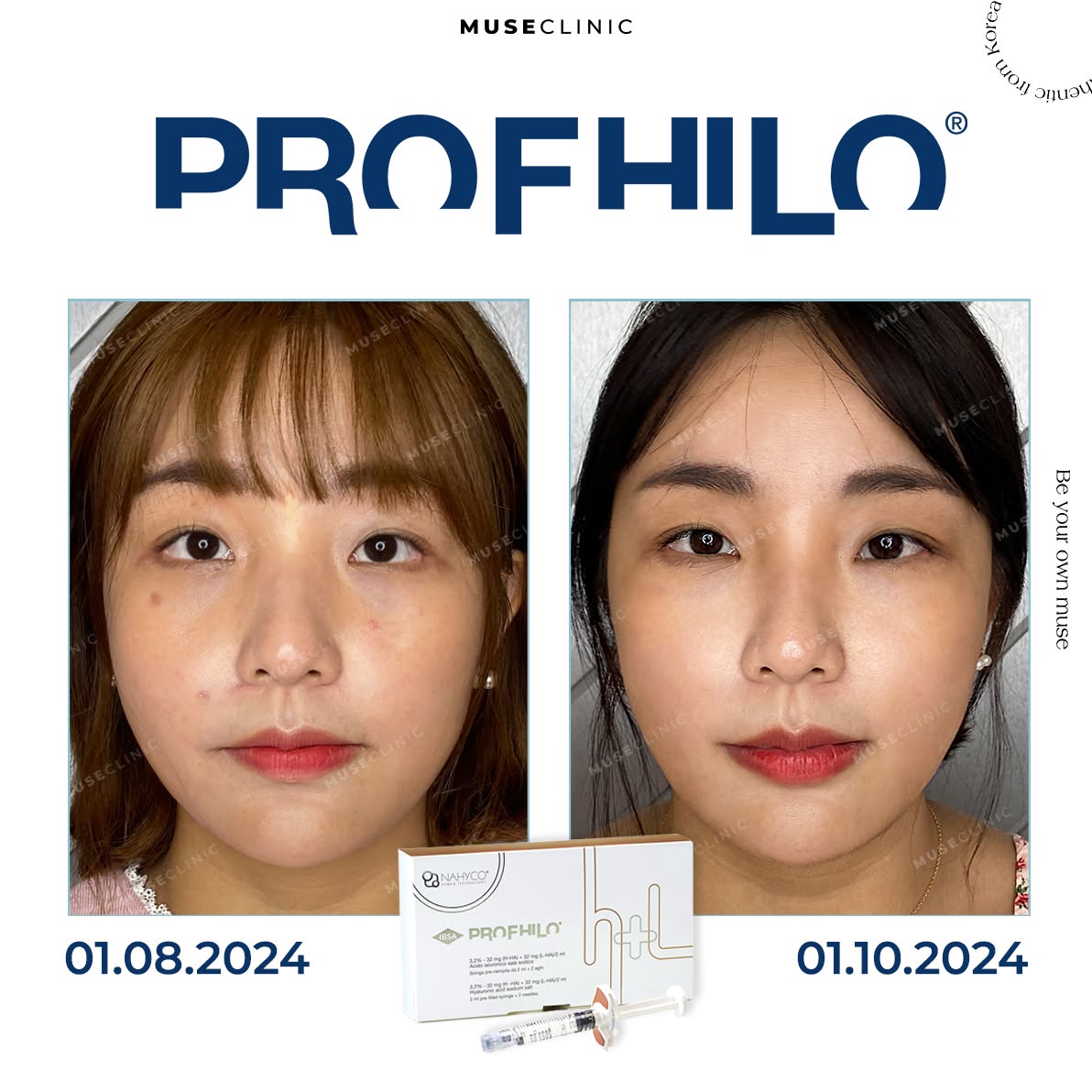 Profhilo Structura - Giải pháp lấp đầy thể tích khuôn mặt cho làn da lão hóa 