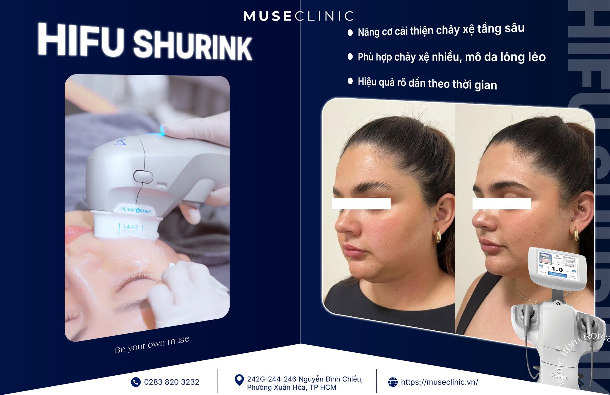 Vì sao giới làm đẹp săn đón công nghệ HIFU Shurink để nâng cơ, thon gọn mặt? 