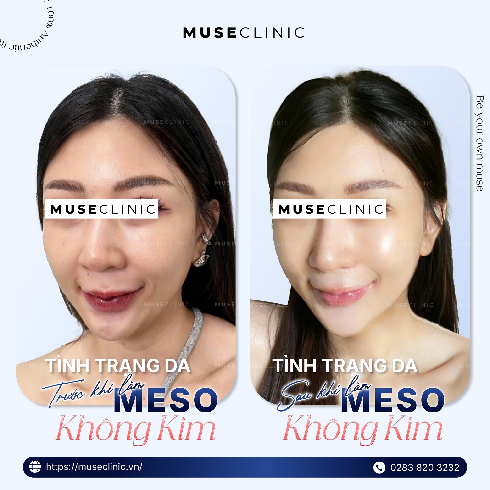 Puraxel - Công nghệ “Meso không kim” giúp cải thiện đa tầng, làm mịn và tăng độ đàn hồi da