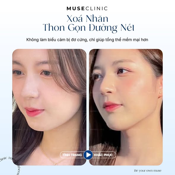 Botox xóa nhăn giữ được bao lâu? Khi nào nên tiêm dặm lại?