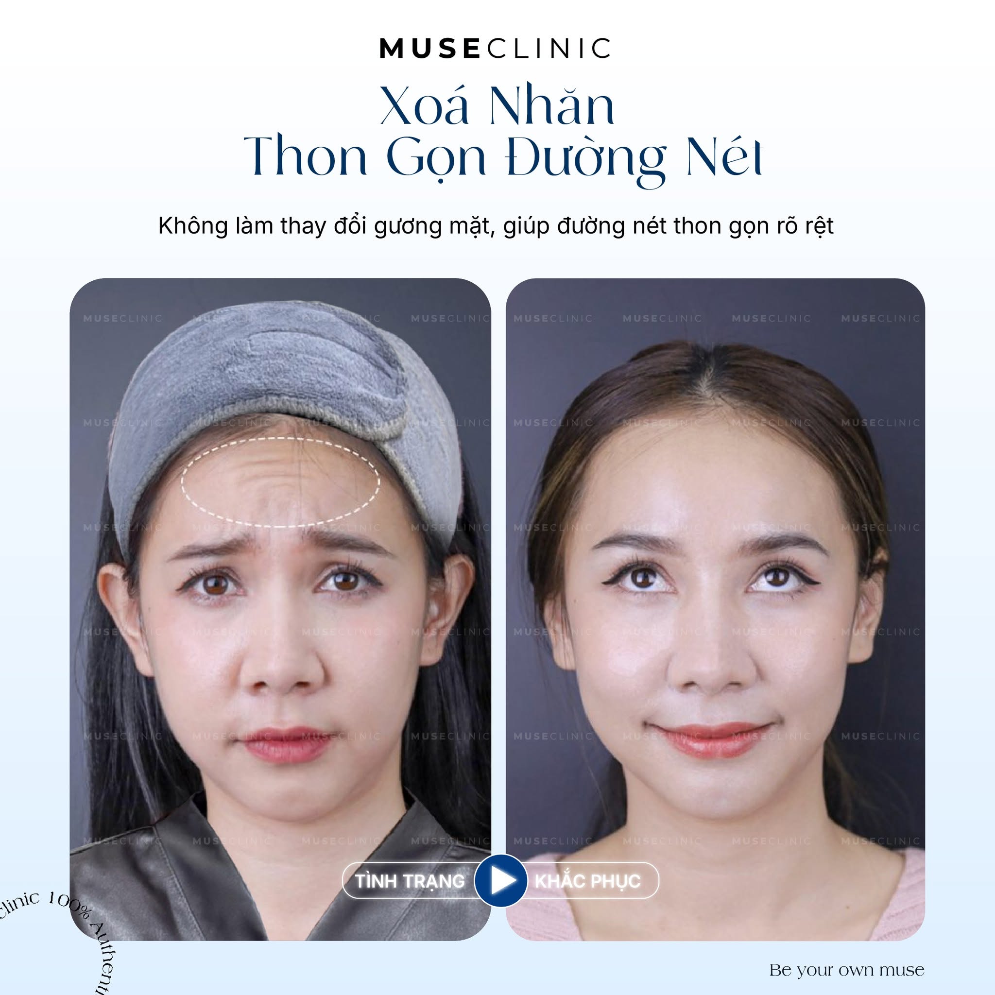 Botox xóa nhăn giữ được bao lâu? Khi nào nên tiêm dặm lại?