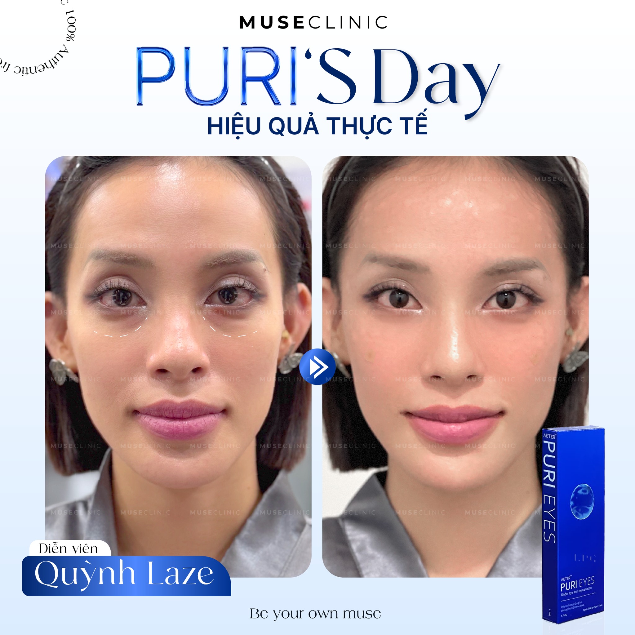 BỘ 3 TRẺ HÓA VÙNG MẮT THẾ HỆ MỚI KHÔNG CẦN PHẪU THUẬT - GIẢI PHÁP CHO ĐÔI MẮT TƯƠI TRẺ TỰ NHIÊN 
