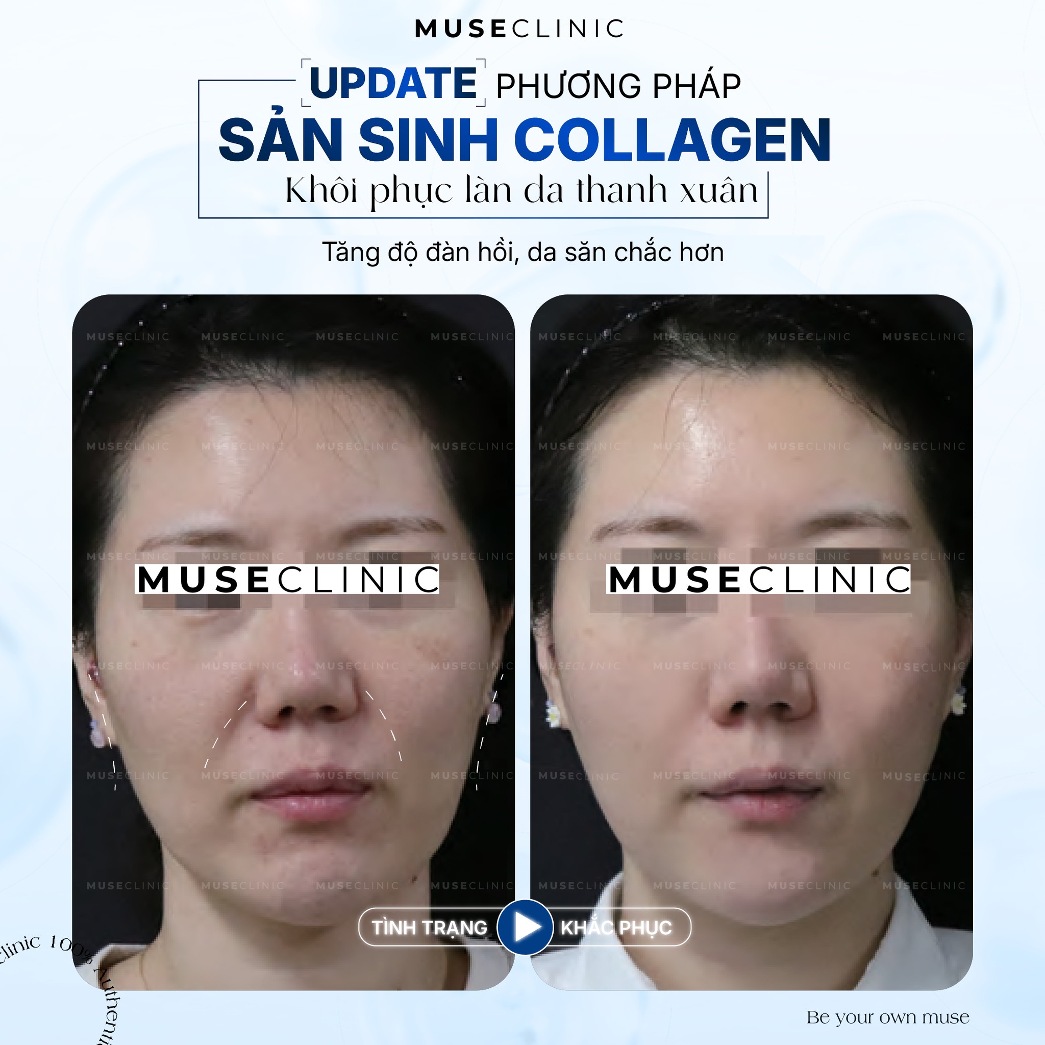 Olidia - Giải pháp phục hồi thể tích gương mặt tự nhiên theo xu hướng trẻ hóa sinh học hiện đại