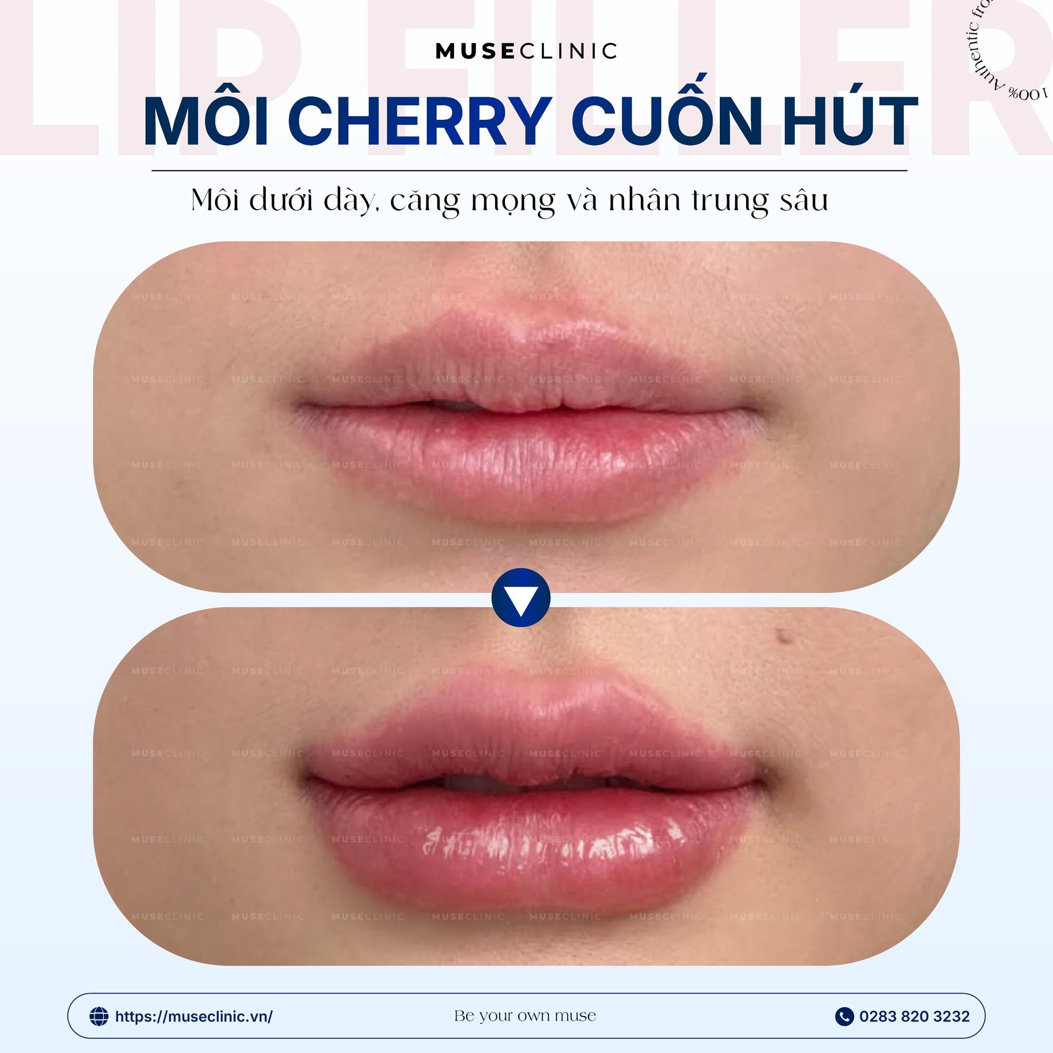 Vì sao Filler lại được ưa chuộng? Nên tiêm Filler ở đâu tại TP.HCM?