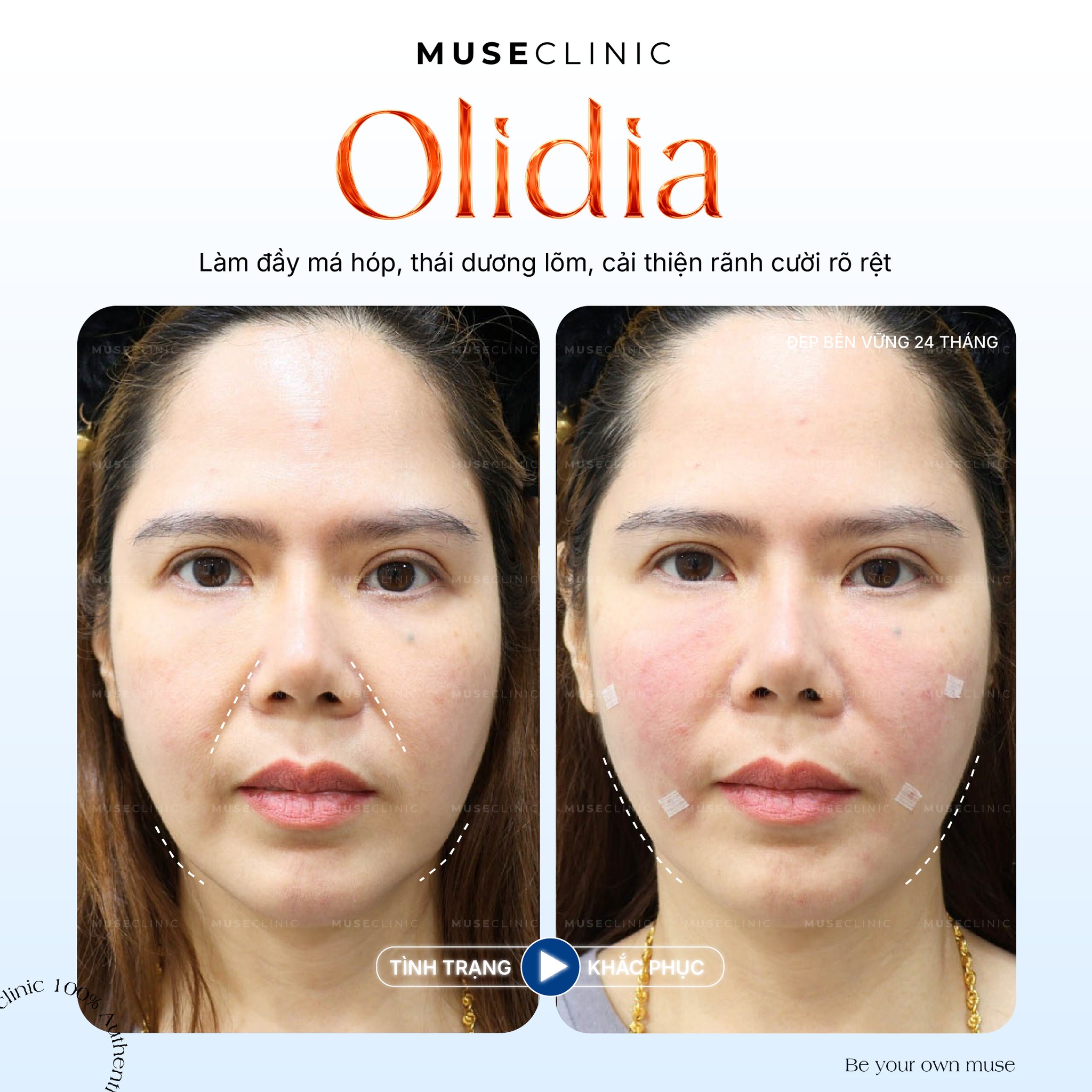 Olidia là gì? Cơ chế tăng sinh collagen tự thân trong trẻ hoá da hiện đại