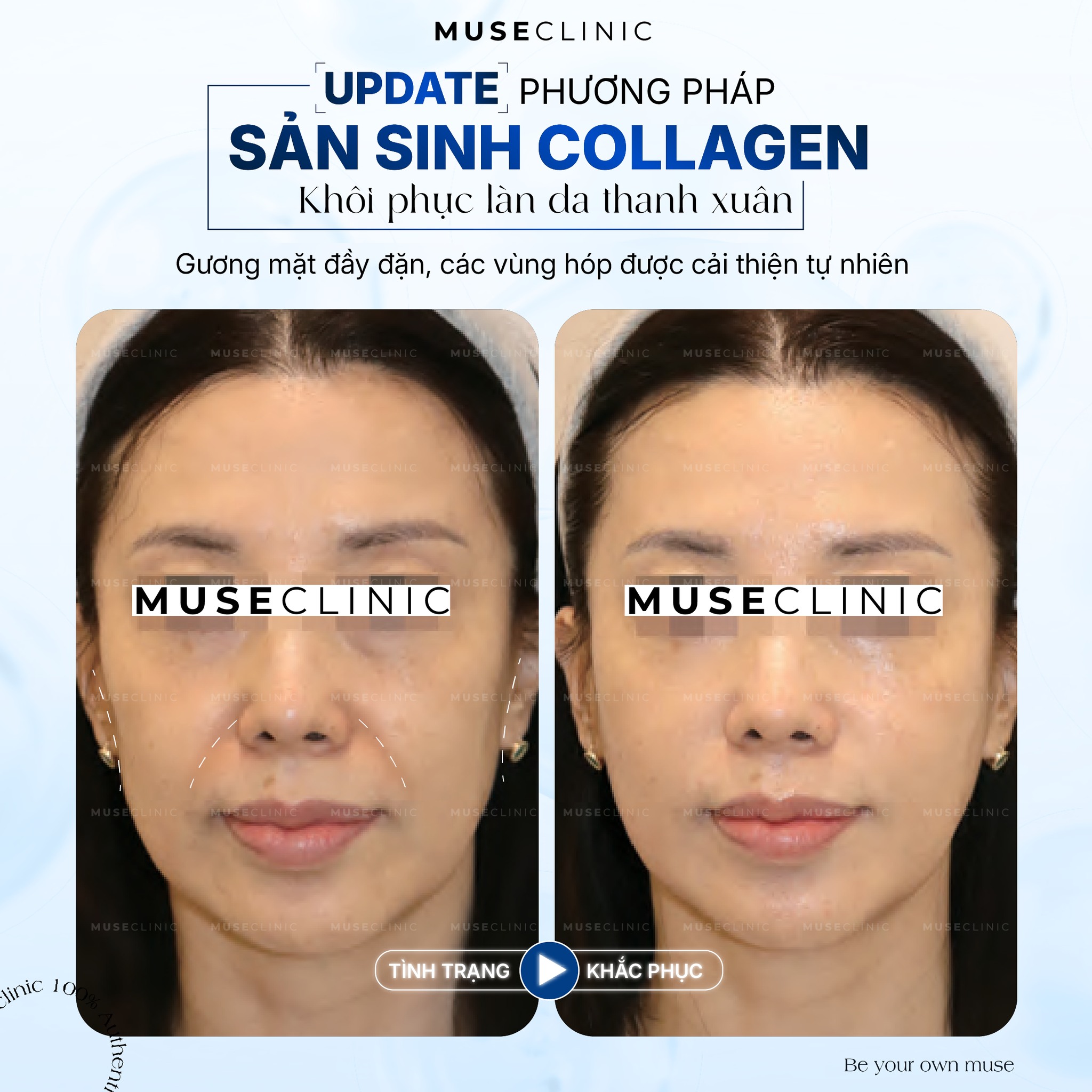 Olidia - Giải pháp phục hồi thể tích gương mặt tự nhiên không cần Filler 