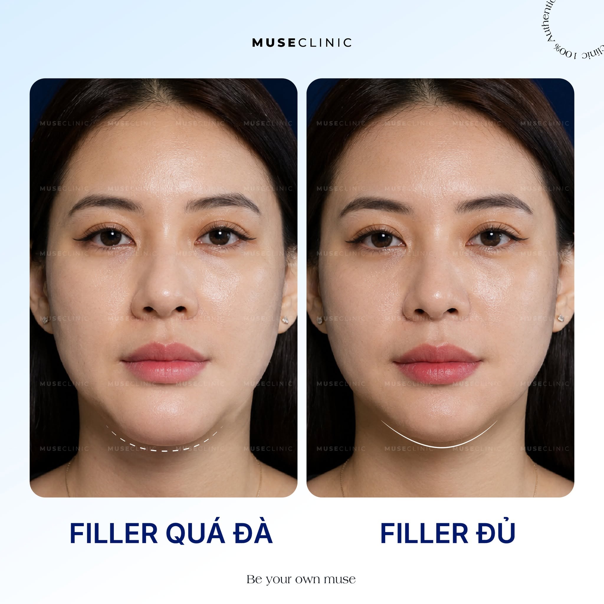 Vì sao Filler lại được ưa chuộng? Nên tiêm Filler ở đâu tại TP.HCM?
