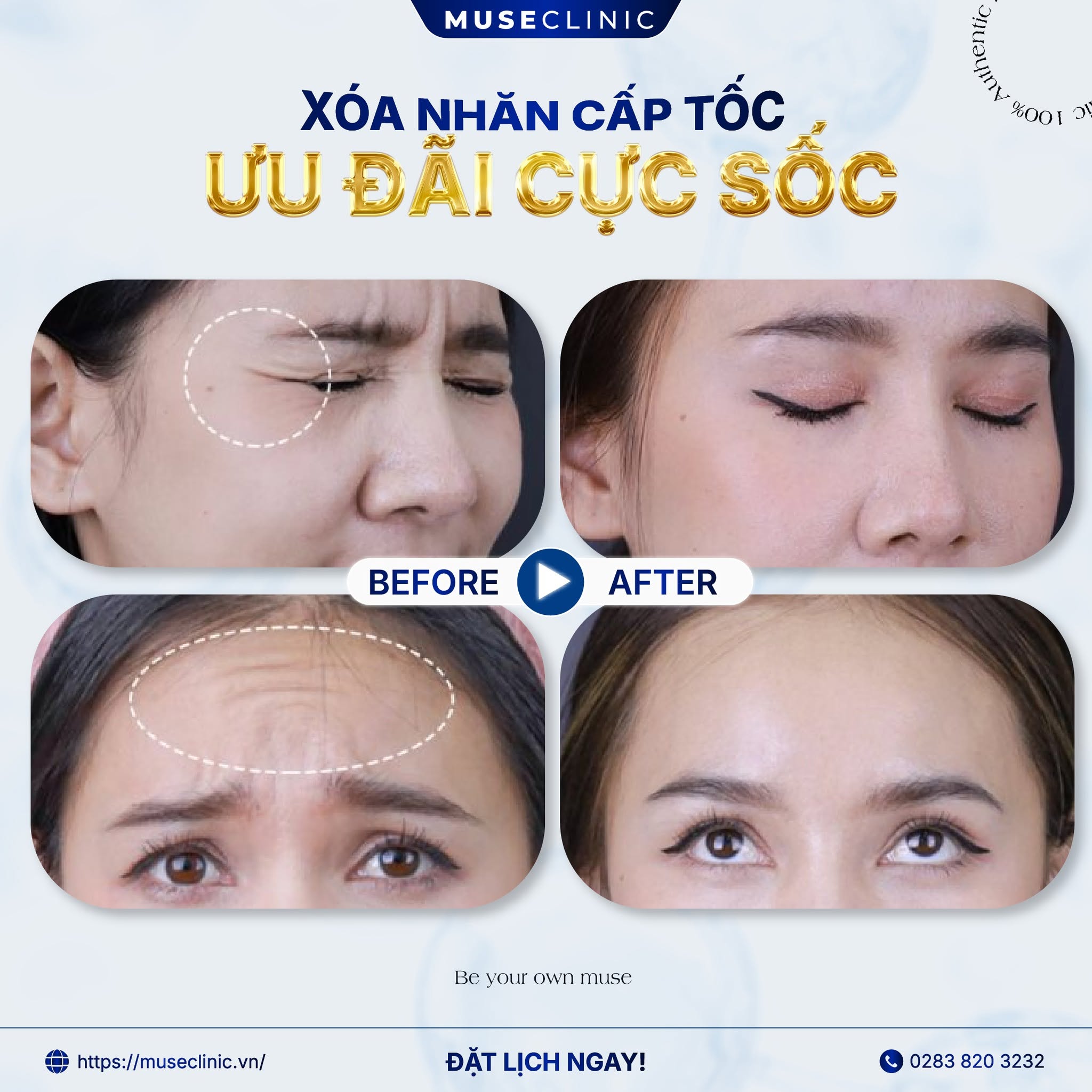 Vì Sao Tiêm Botox Nhiều Lần Không Còn Hiệu Quả Như Trước? Cách Khắc Phục Lờn Botox Từ Chuyên Gia 