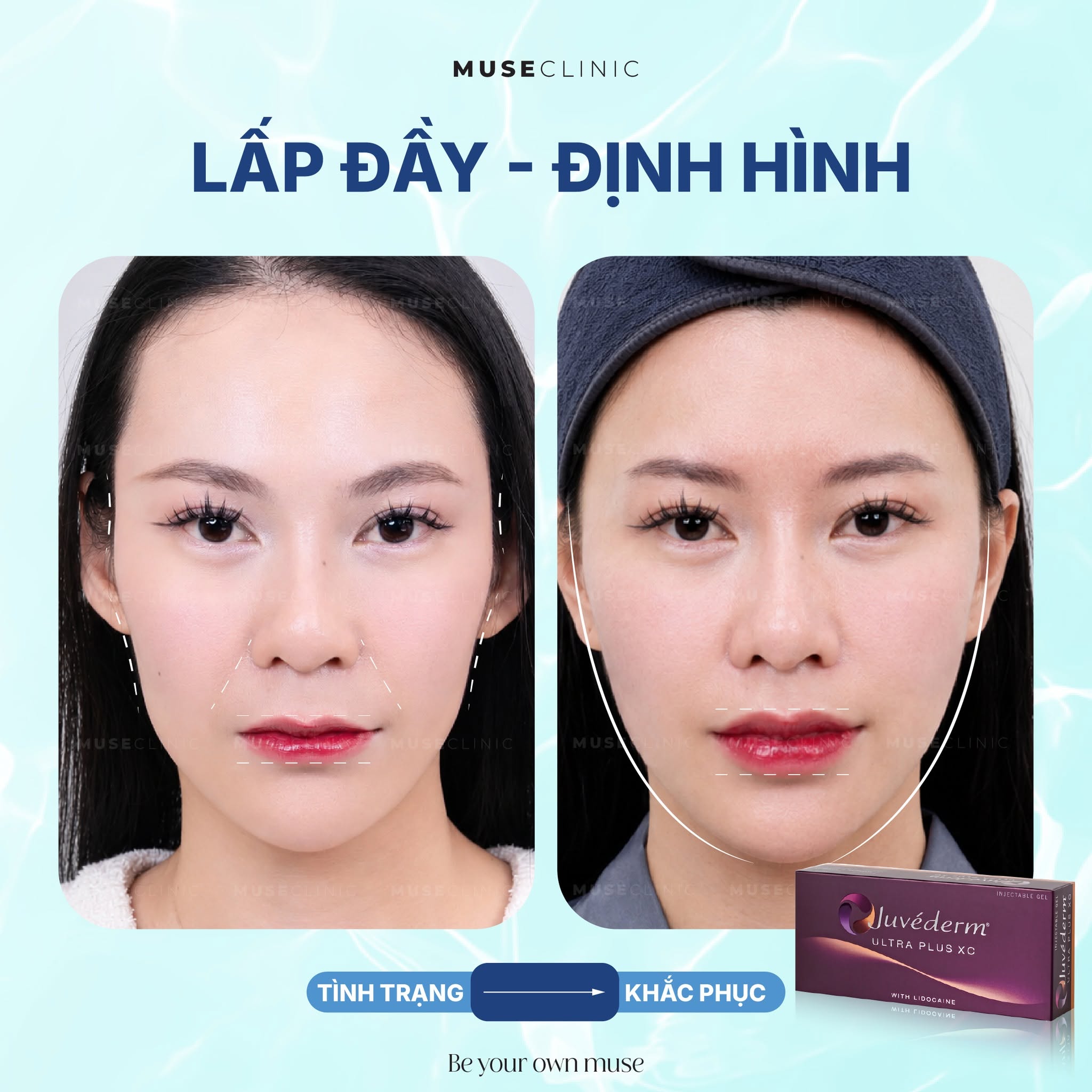Vì sao Filler lại được ưa chuộng? Nên tiêm Filler ở đâu tại TP.HCM?