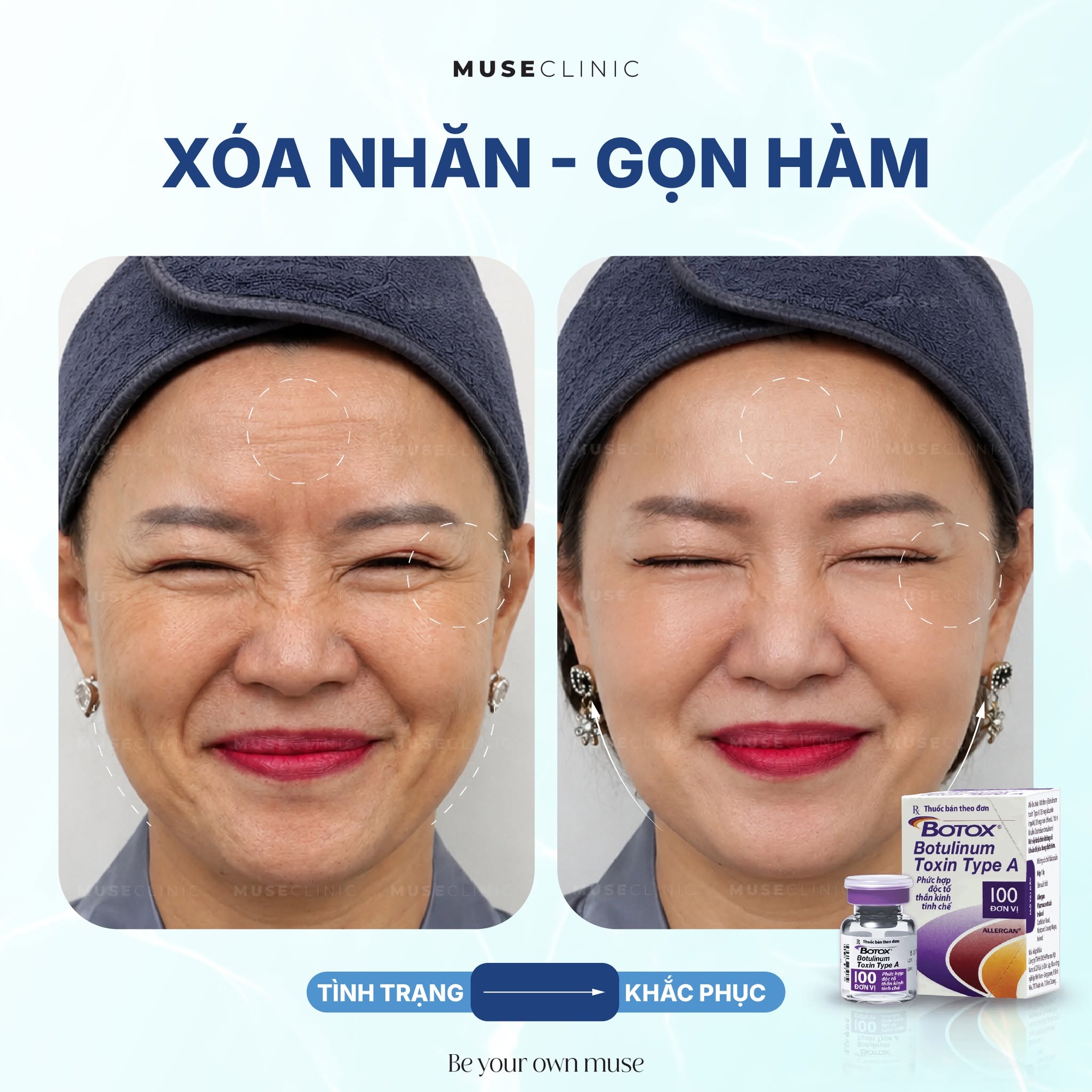 Botox xóa nhăn giữ được bao lâu? Khi nào nên tiêm dặm lại?