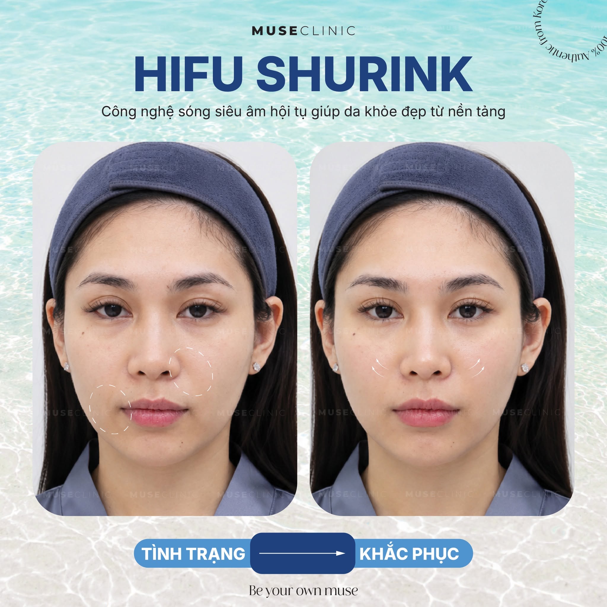 Vì sao giới làm đẹp săn đón công nghệ HIFU Shurink để nâng cơ, thon gọn mặt? 