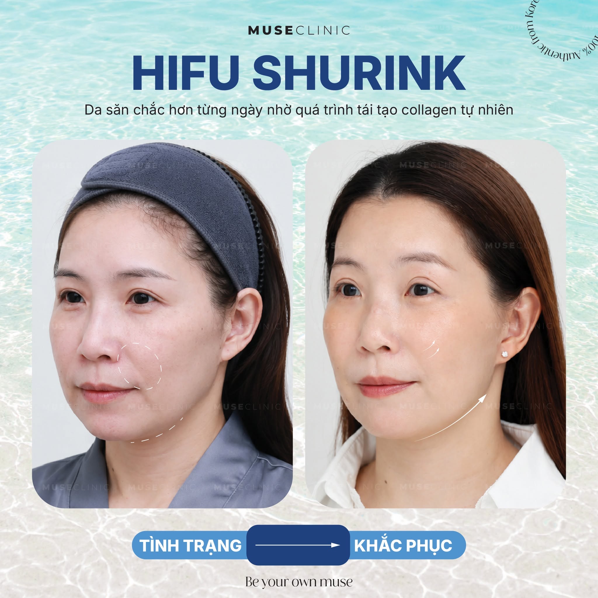 Vì sao giới làm đẹp săn đón công nghệ HIFU Shurink để nâng cơ, thon gọn mặt? 