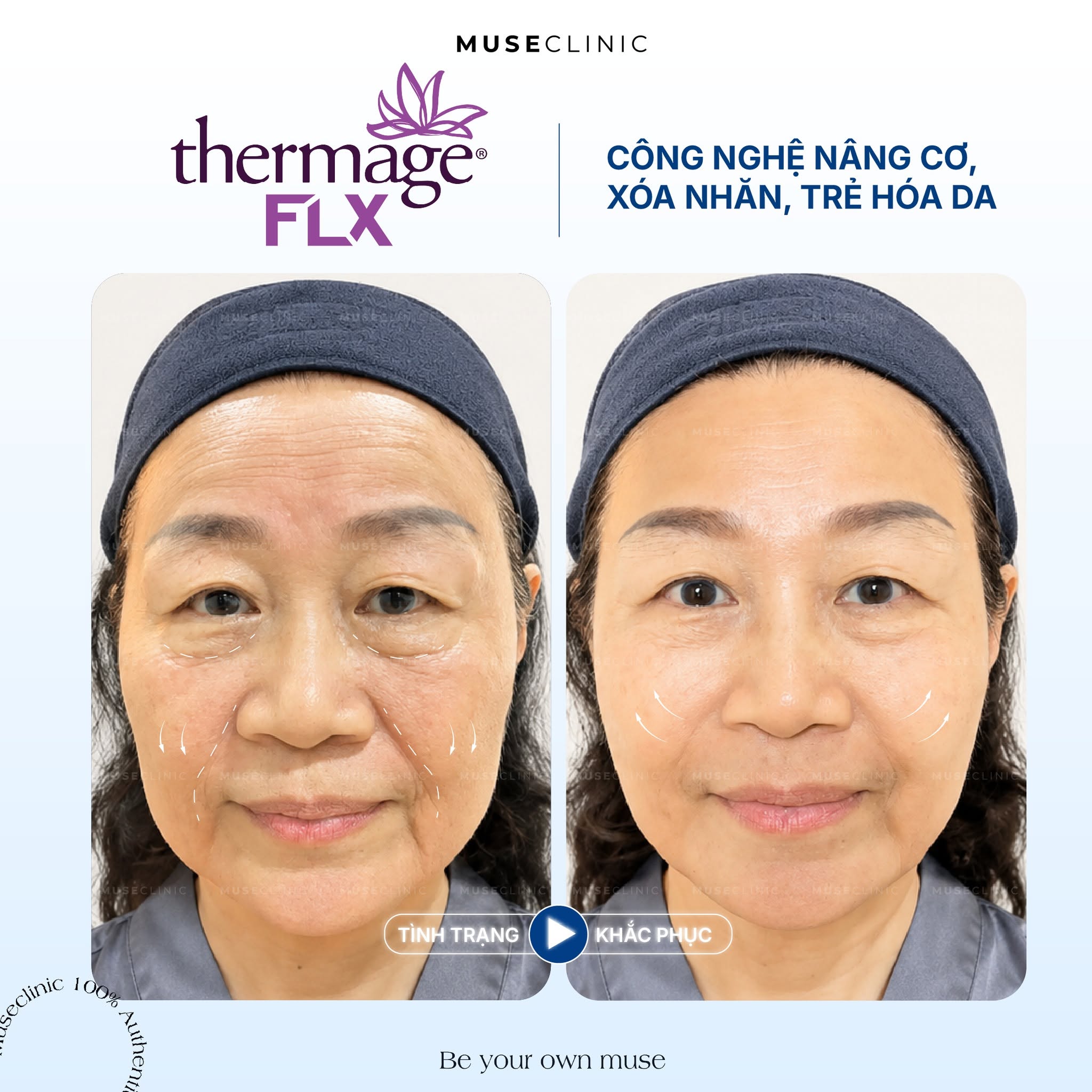 Trẻ hoá da Thermage FLX: Công nghệ nâng cơ xóa nhăn an toàn hiệu quả