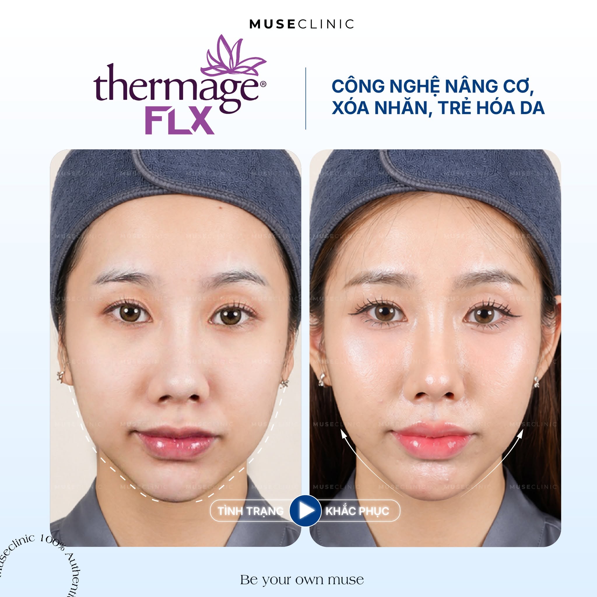 Trẻ hoá da Thermage FLX: Công nghệ nâng cơ xóa nhăn an toàn hiệu quả