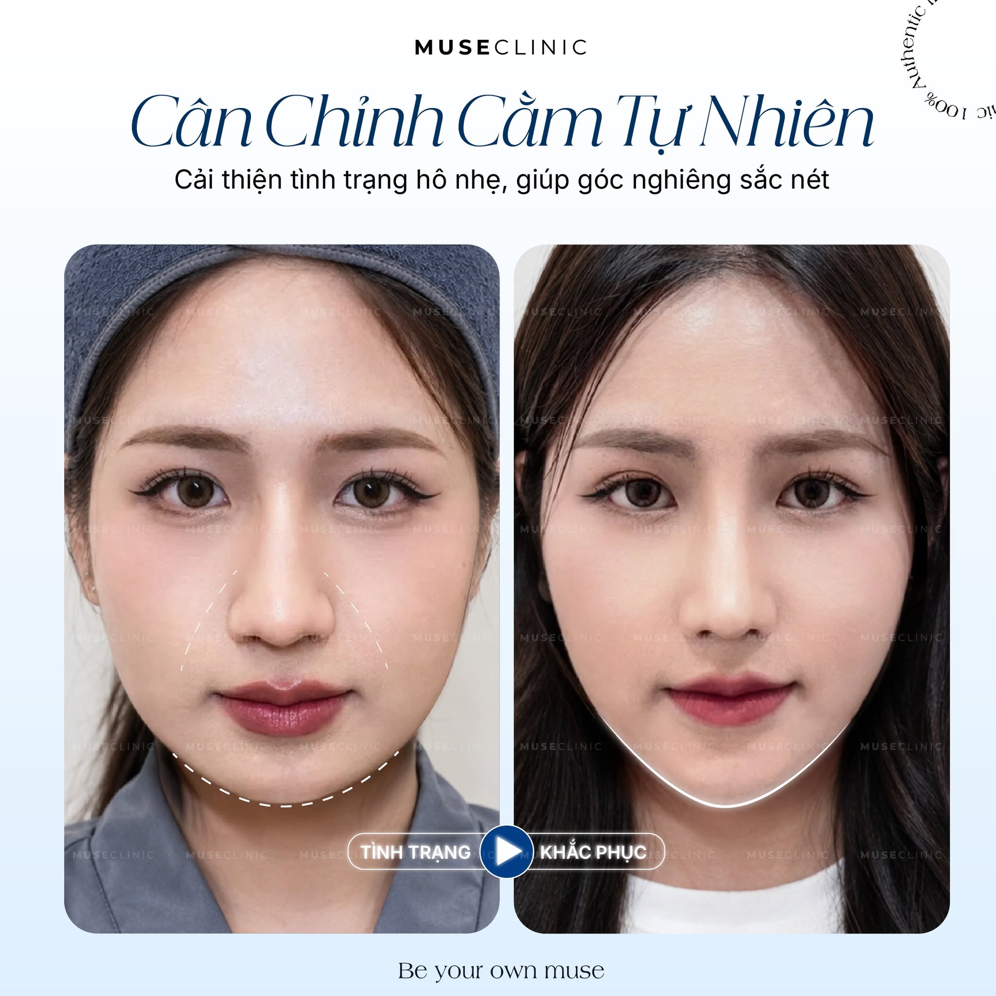 Không Chỉ Làm Đầy: 3 Ứng Dụng Bất Ngờ Của Hyaluronic Acid Trong Thẩm Mỹ Bạn Nên Biết