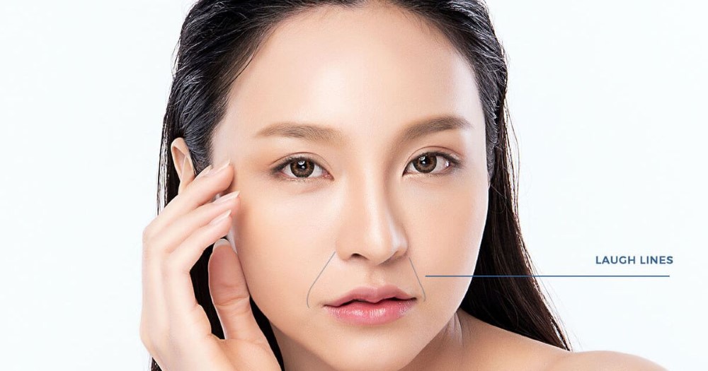 Cách Botox giúp bạn loại bỏ nếp nhăn rãnh cười nhanh chóng