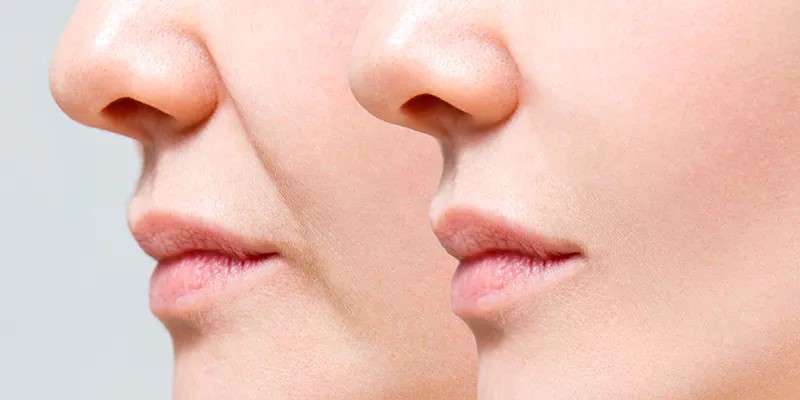 Rãnh cười đẹp hay xấu? Cách làm đầy rãnh cười tự nhiên bằng Botox