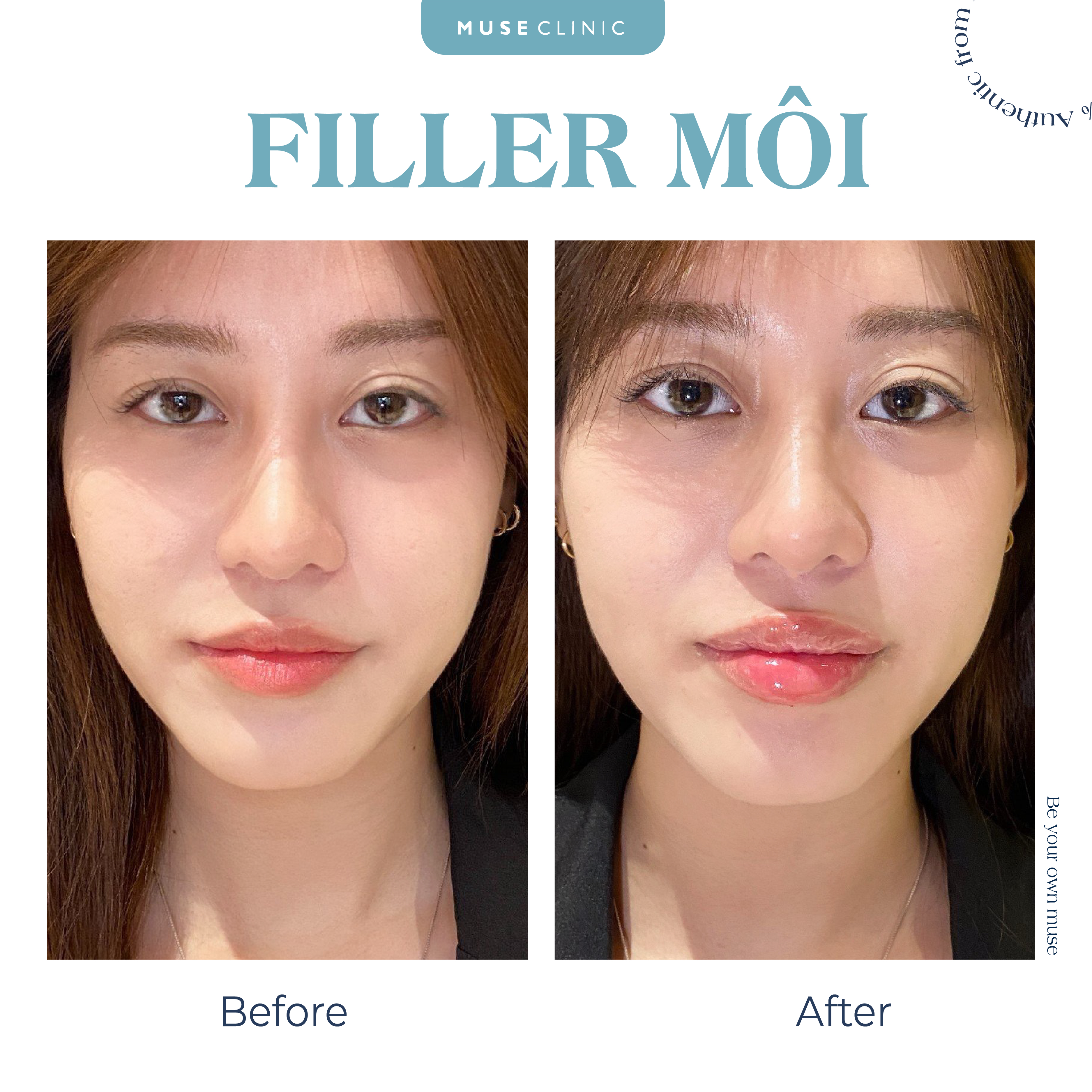 Cân chỉnh khuôn mặt toàn diện với phương pháp tiêm Filler