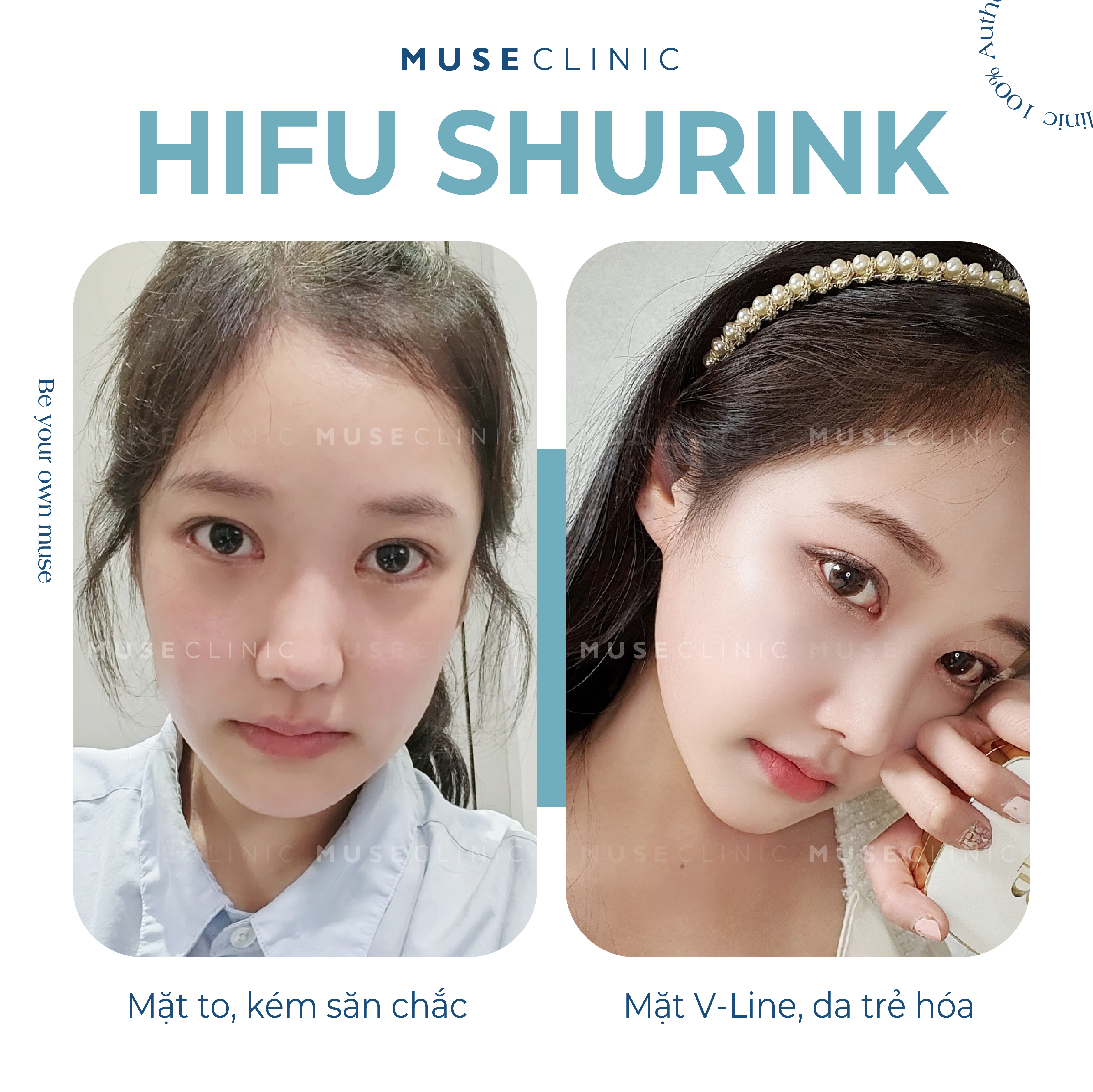 Top 5 công nghệ nâng cơ, trẻ hóa da nổi bật hiện nay