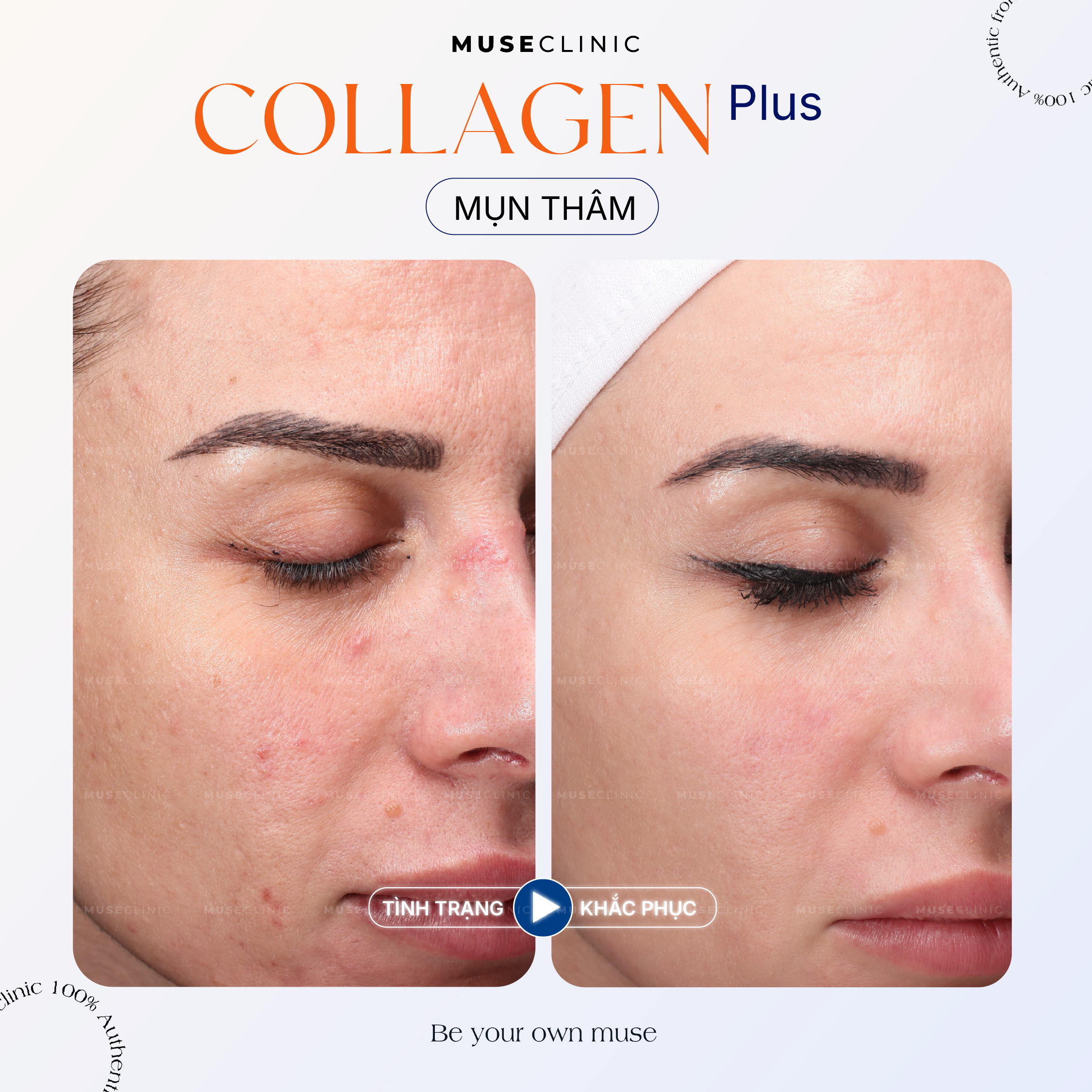Linersae Collagen - Giải pháp trẻ hóa sinh học chuẩn y khoa Châu Âu giúp tái tạo làn da từ bên trong 