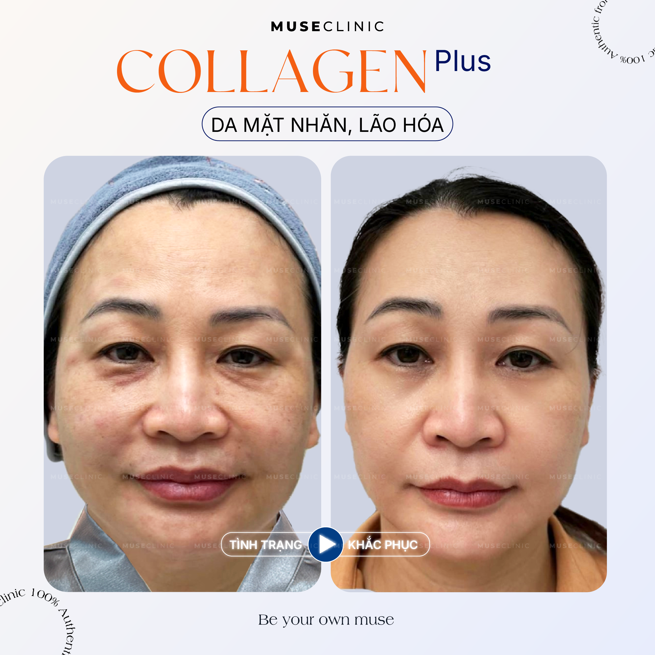Linersae Collagen - Giải pháp trẻ hóa sinh học chuẩn y khoa Châu Âu giúp tái tạo làn da từ bên trong 