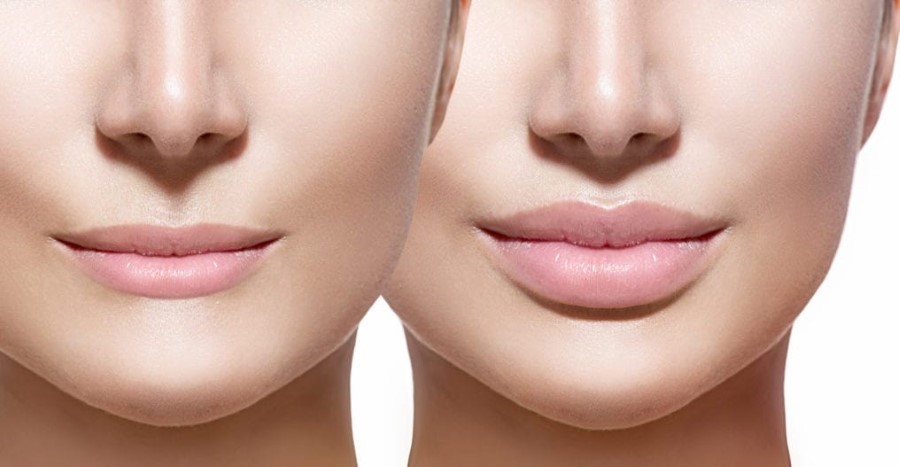 Tư vấn chọn loại filler phù hợp để tạo dáng môi Tây quyến rũ