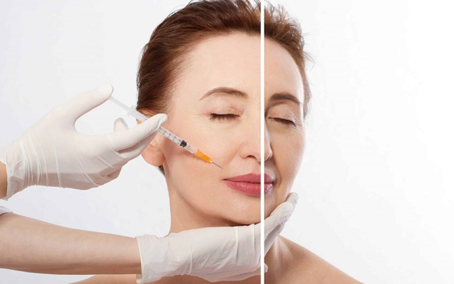 Tiêm filler rãnh cười sâu nên chọn loại nào tốt?