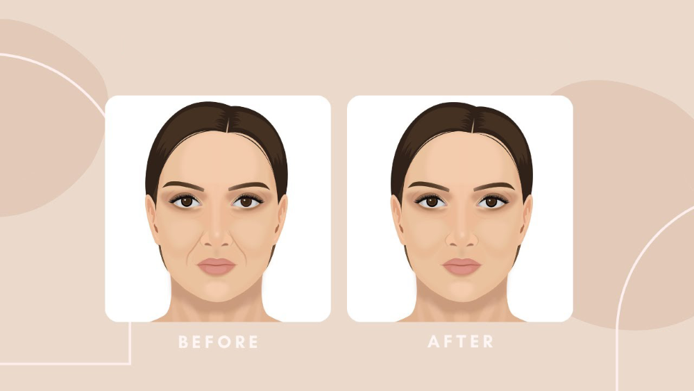 Có nên tiêm rãnh cười bằng Botox không? Ưu và nhược điểm