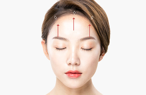 Các nếp nhăn trên cổ có thể được xóa bỏ bằng Botox không?