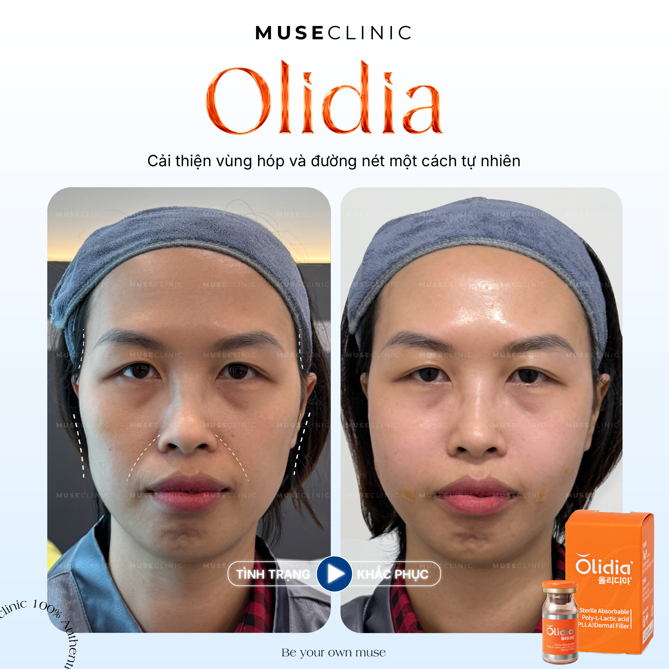Olidia là gì? Cơ chế tăng sinh collagen tự thân trong trẻ hoá da hiện đại