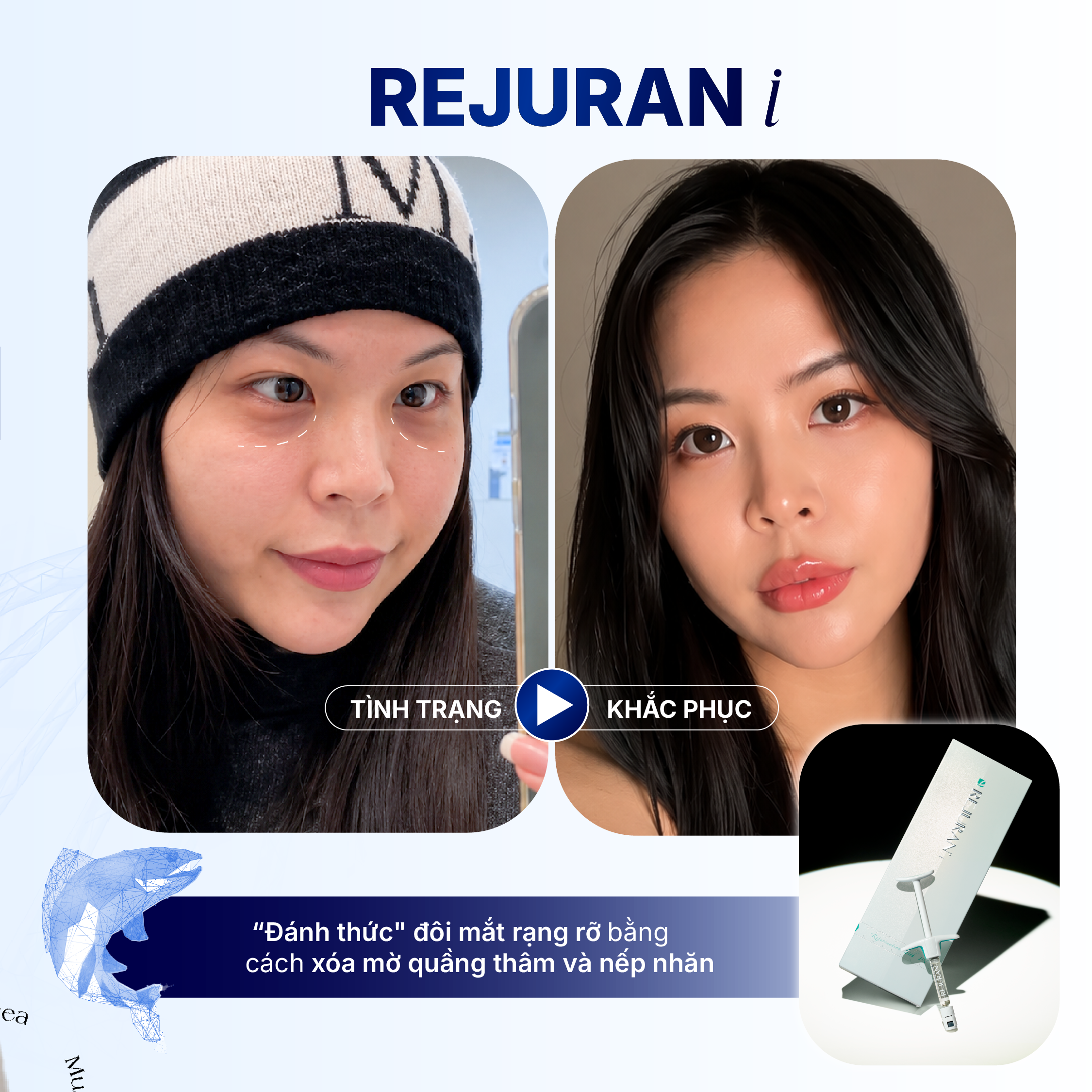BỘ 3 TRẺ HÓA VÙNG MẮT THẾ HỆ MỚI KHÔNG CẦN PHẪU THUẬT - GIẢI PHÁP CHO ĐÔI MẮT TƯƠI TRẺ TỰ NHIÊN 
