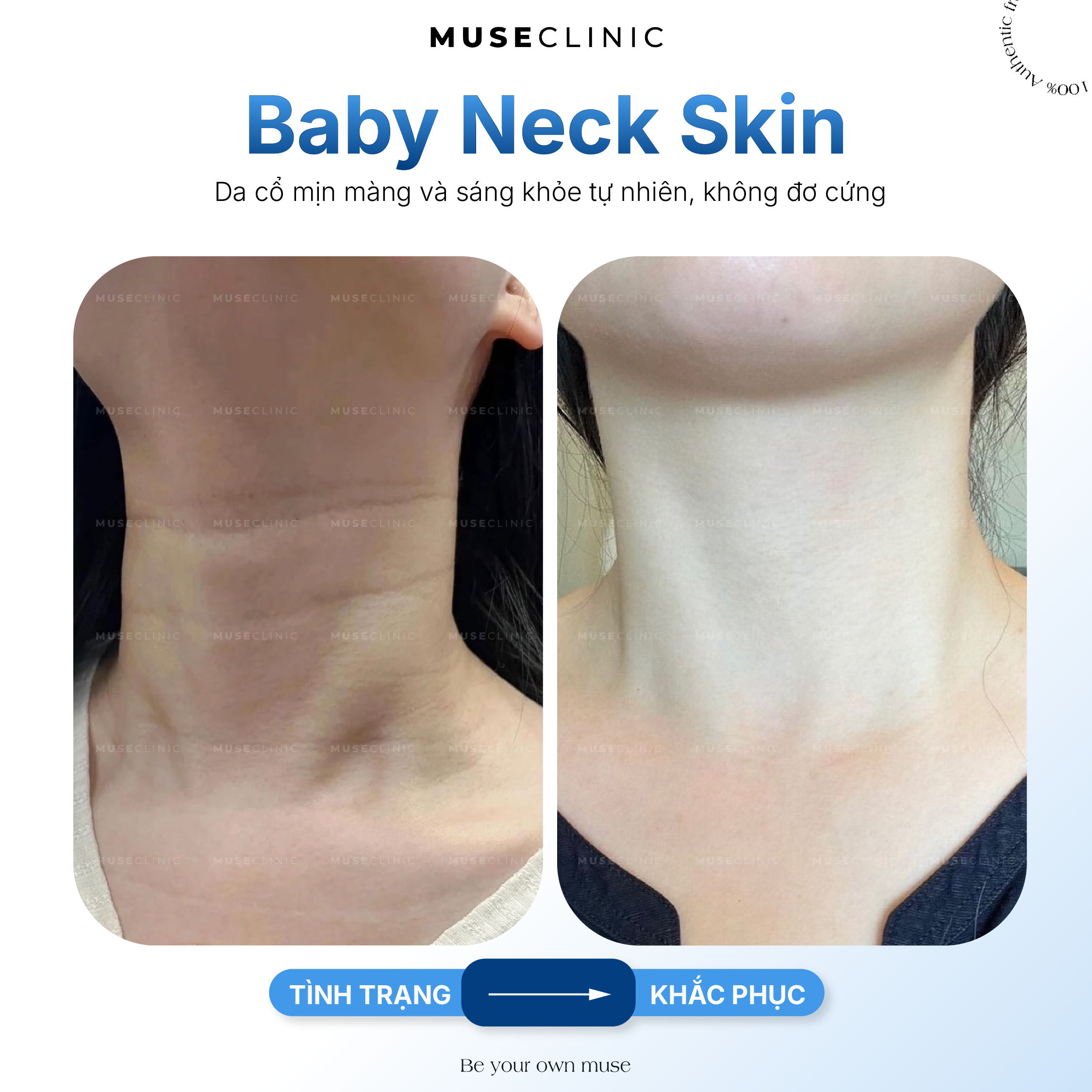 Trẻ hóa vùng cổ: Giải pháp làm mờ nếp nhăn cổ tự nhiên với Baby Neck Skin