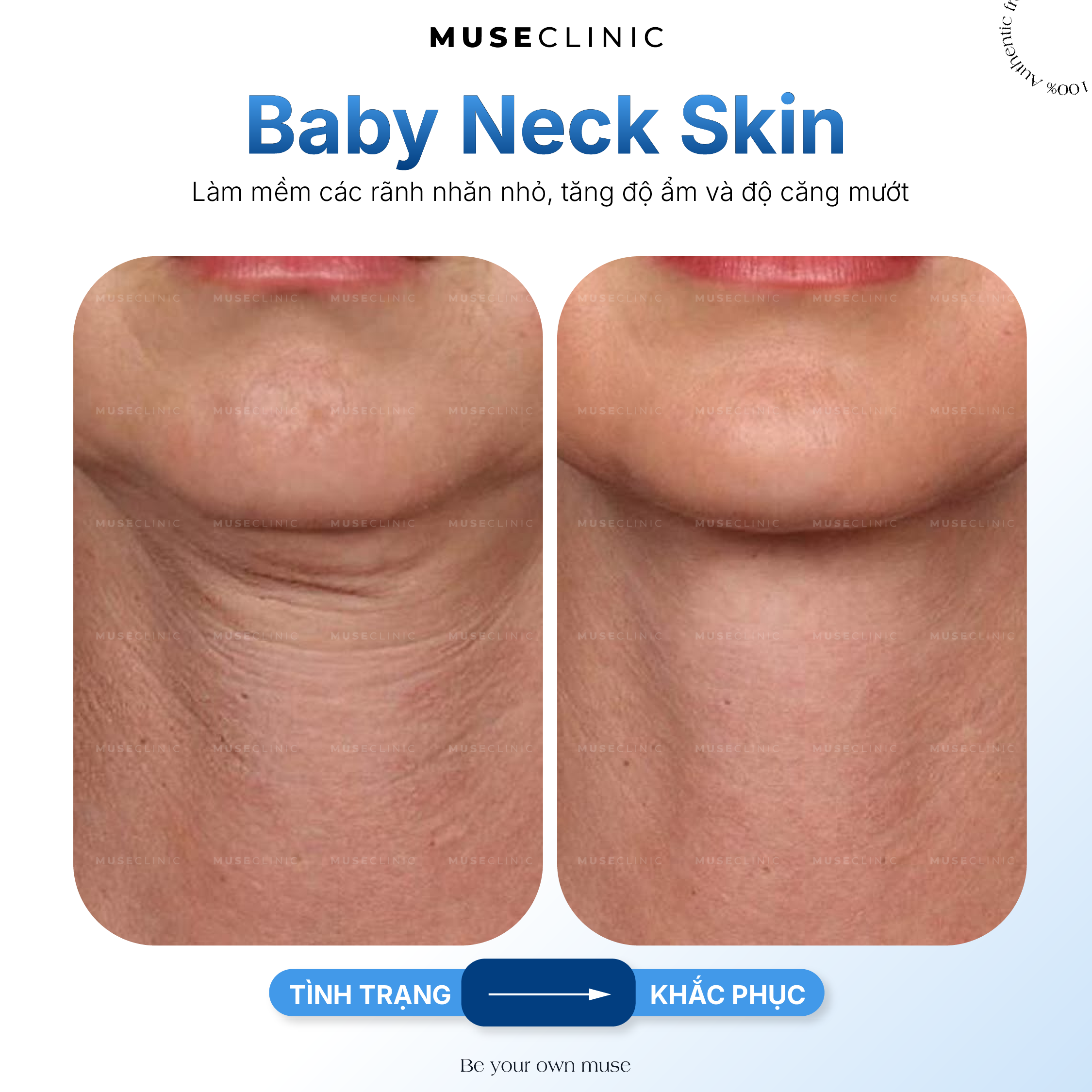 Trẻ hóa vùng cổ: Giải pháp làm mờ nếp nhăn cổ tự nhiên với Baby Neck Skin