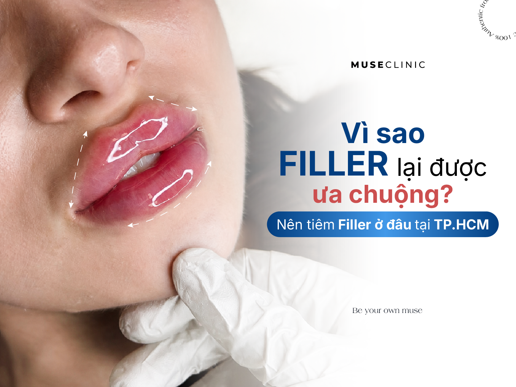 Vì sao Filler lại được ưa chuộng? Nên tiêm Filler ở đâu tại TP.HCM?
