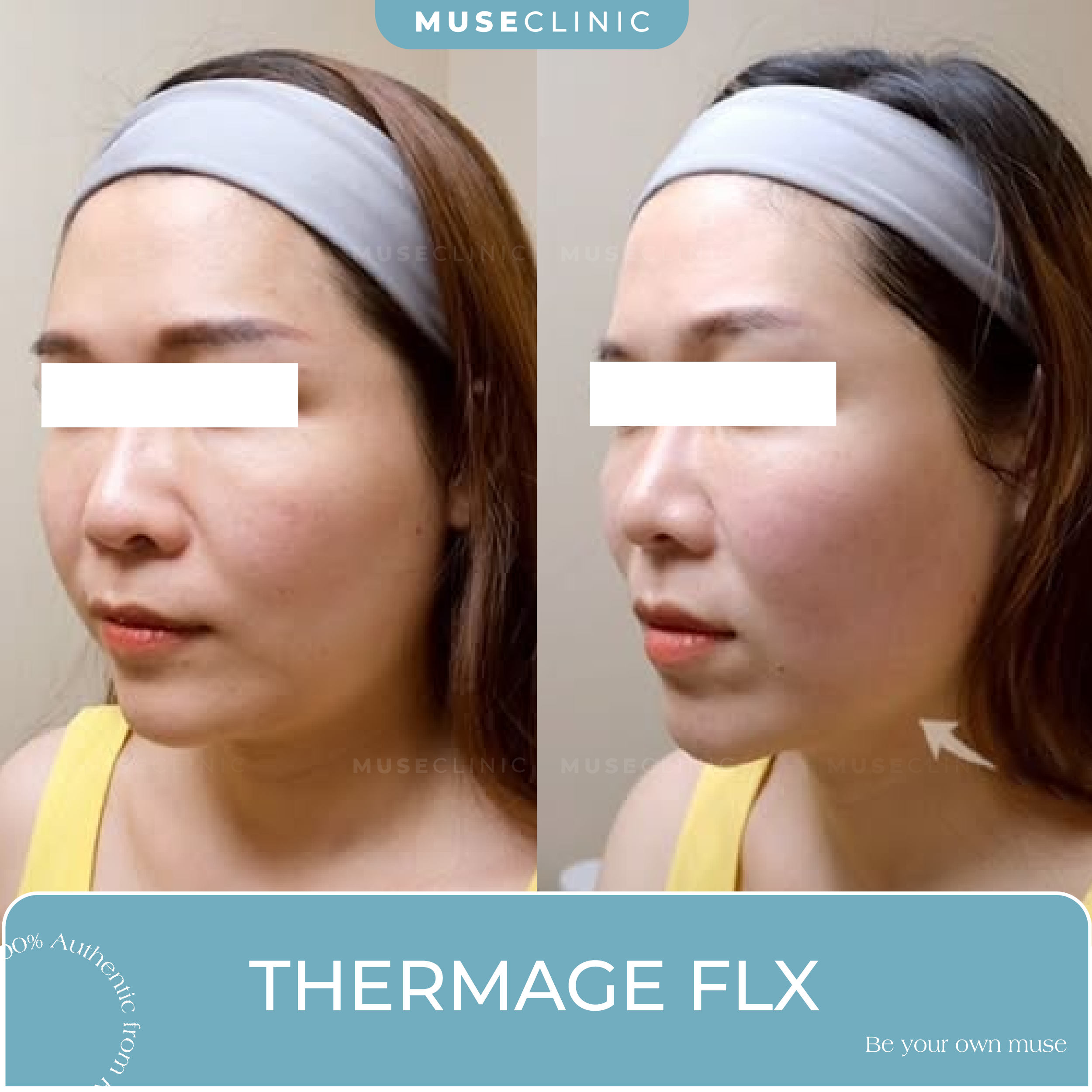 Top 5 công nghệ nâng cơ, trẻ hóa da nổi bật hiện nay