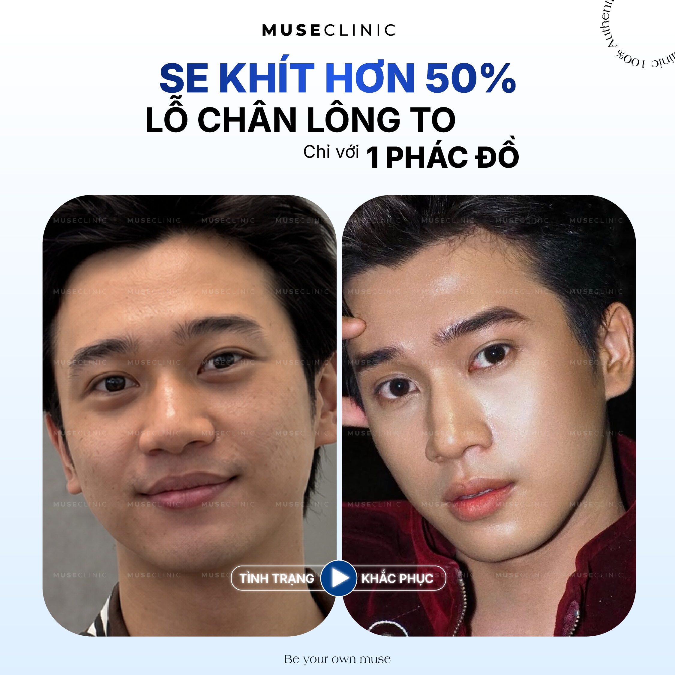 Tại Sao Lỗ Chân Lông Càng Ngày Càng To Và Cách Khắc Phục Hiệu Quả?
