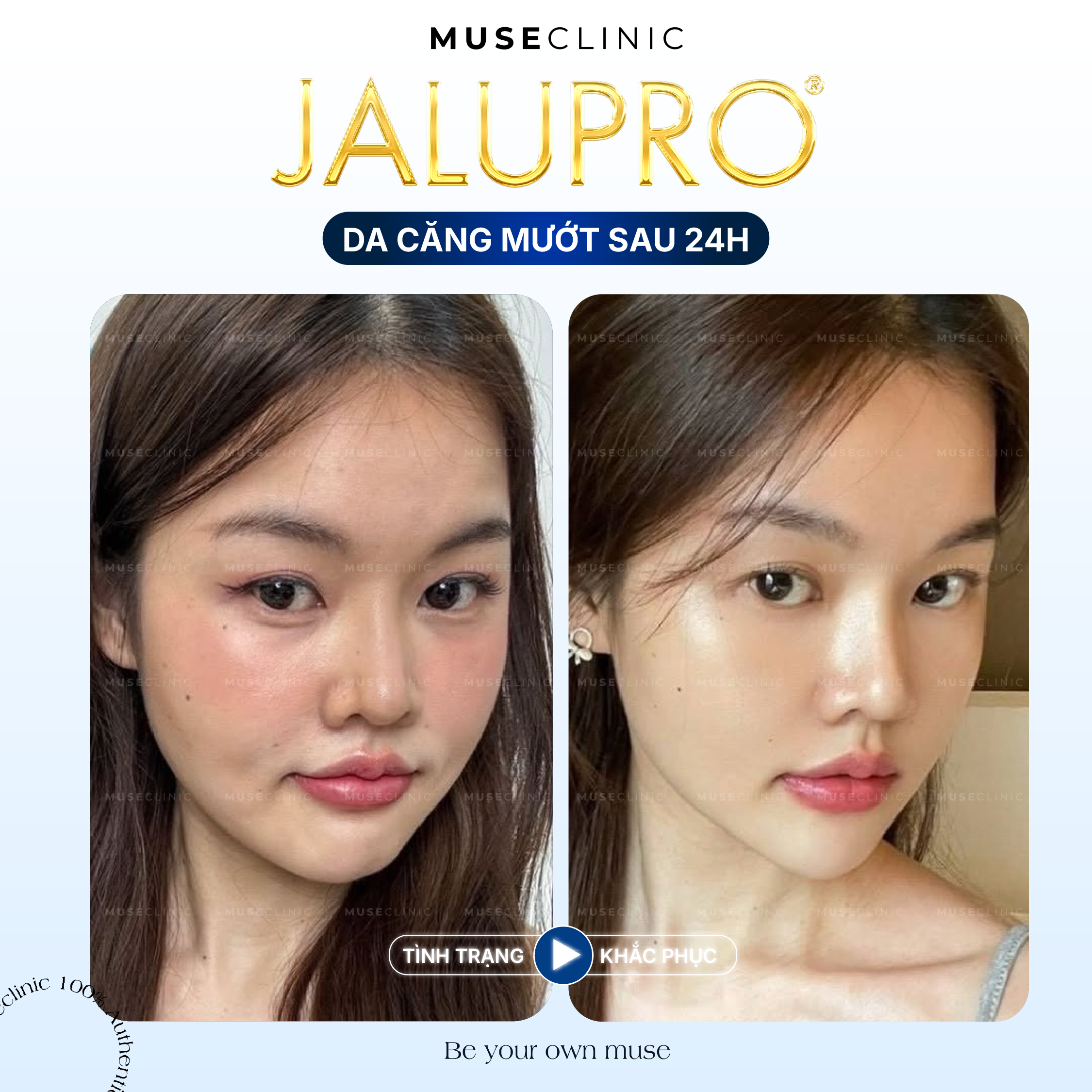 Jalupro Extra – Giải pháp trẻ hóa da sinh học sâu từ bên trong
