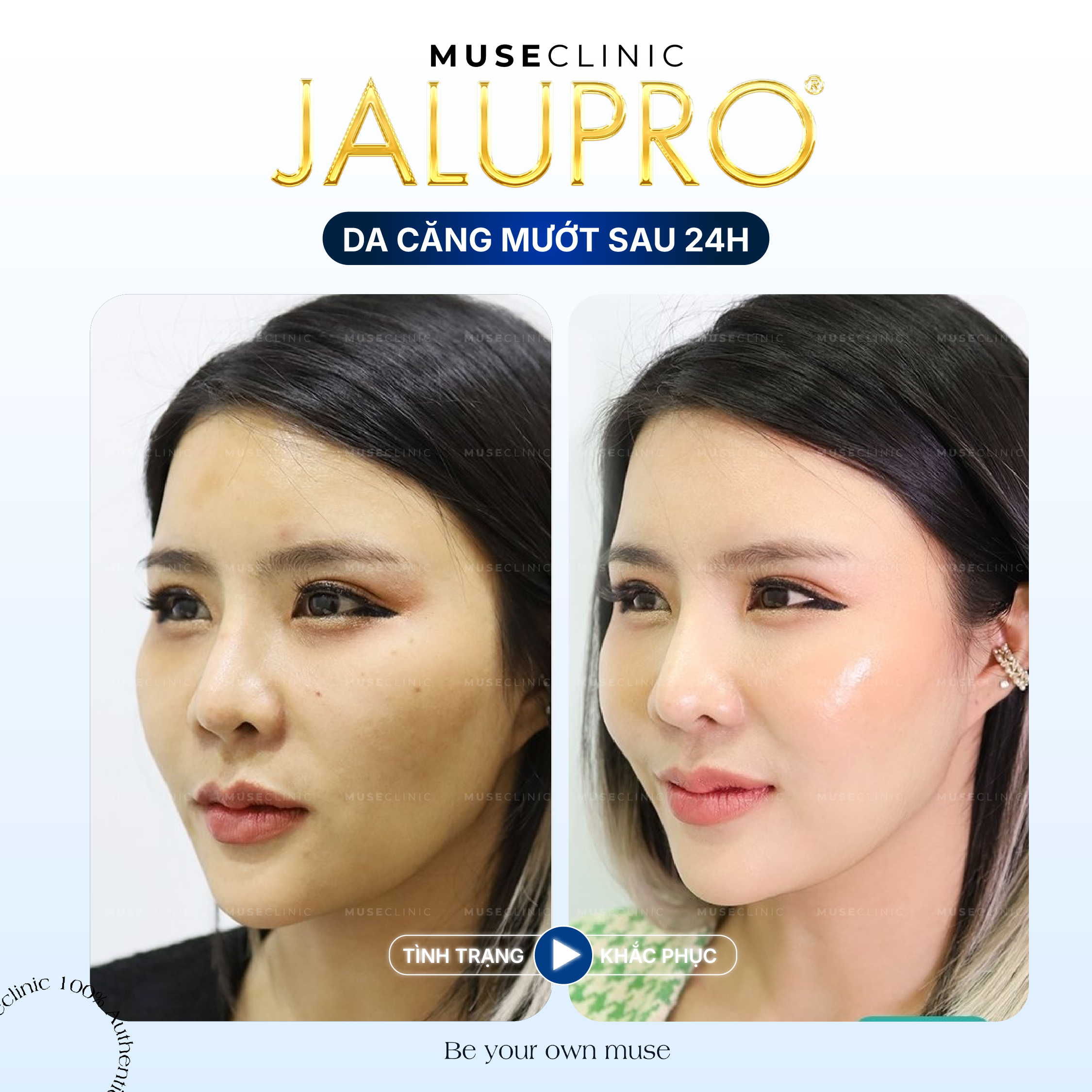 Jalupro Extra – Giải pháp trẻ hóa da sinh học sâu từ bên trong