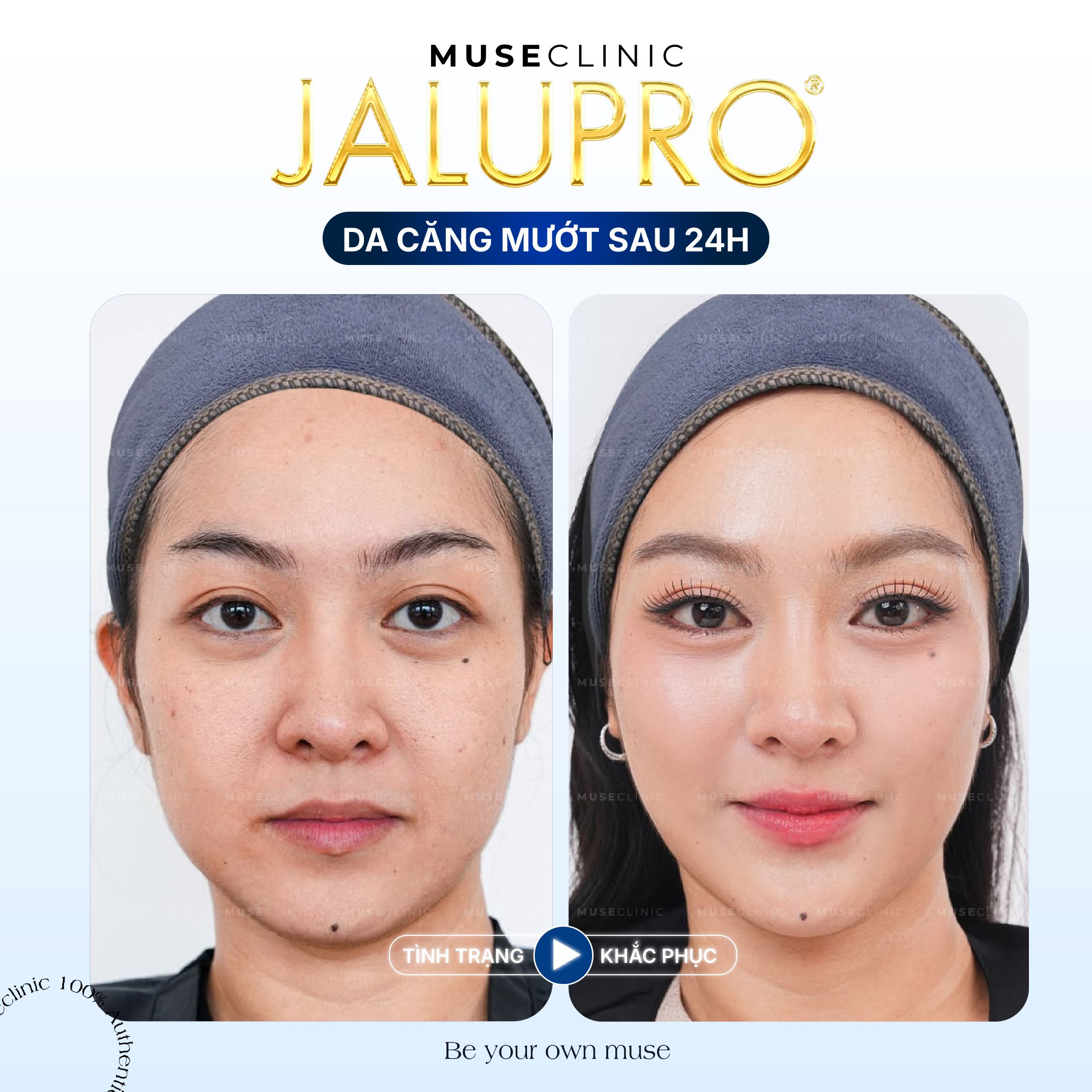 Jalupro Extra – Giải pháp trẻ hóa da sinh học sâu từ bên trong