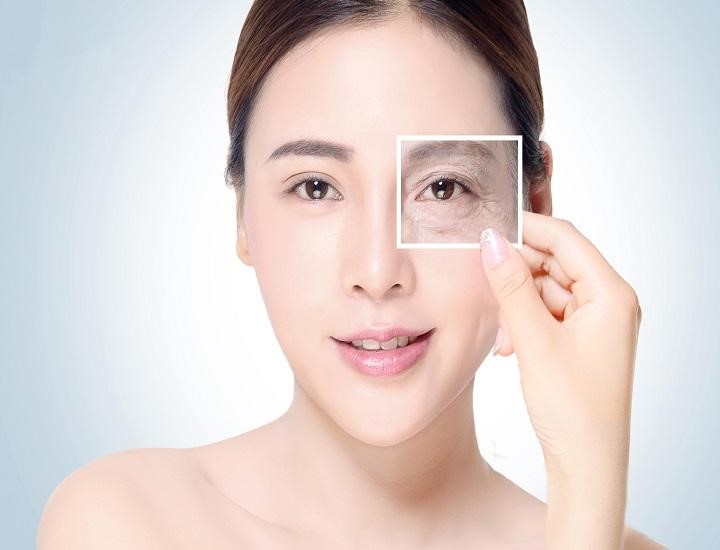 Xóa nhăn đuôi mắt bằng Botox giữ được bao lâu?