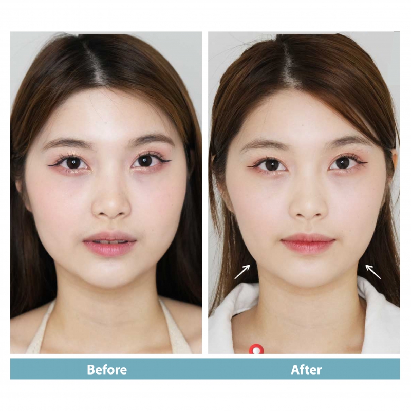 Botox thon gọn hàm