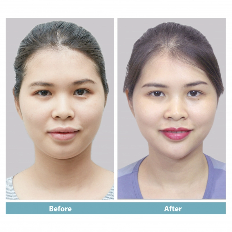 Chin filler