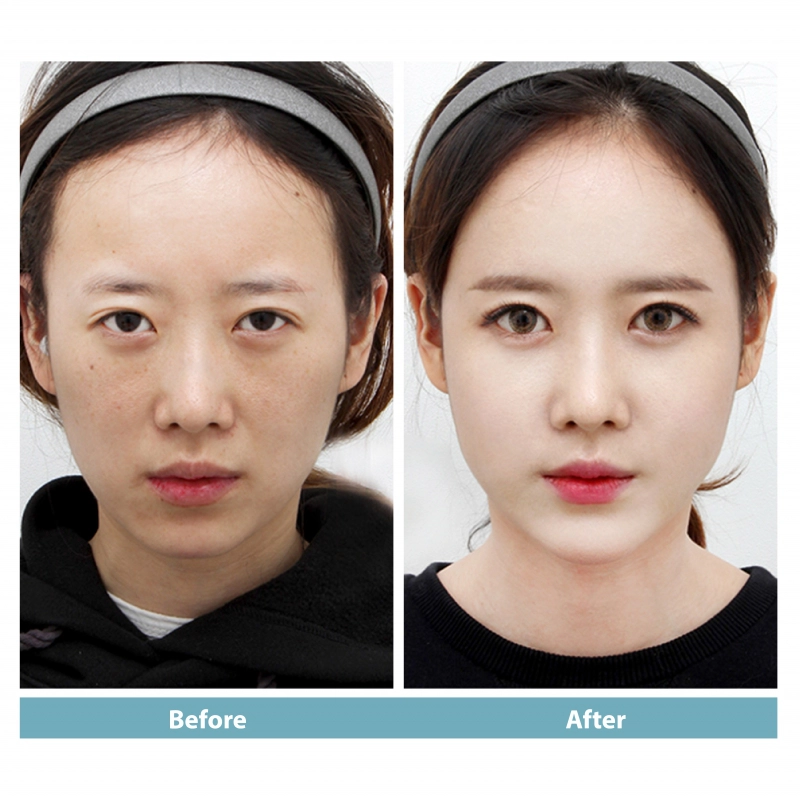 Forehead/Temporal filler