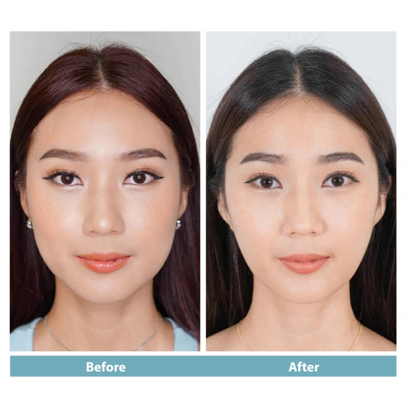SMAS ULTHERAPY